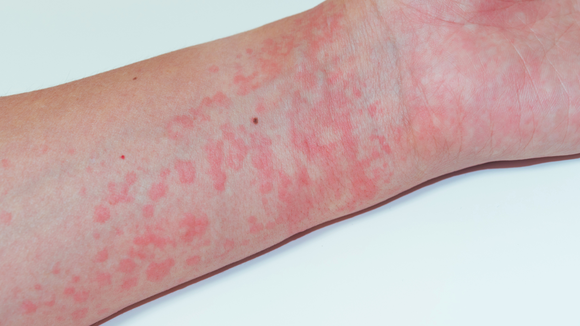 Nổi mề đay có thể khiến da nổi mẩn đỏ ngứa như muỗi đốt​