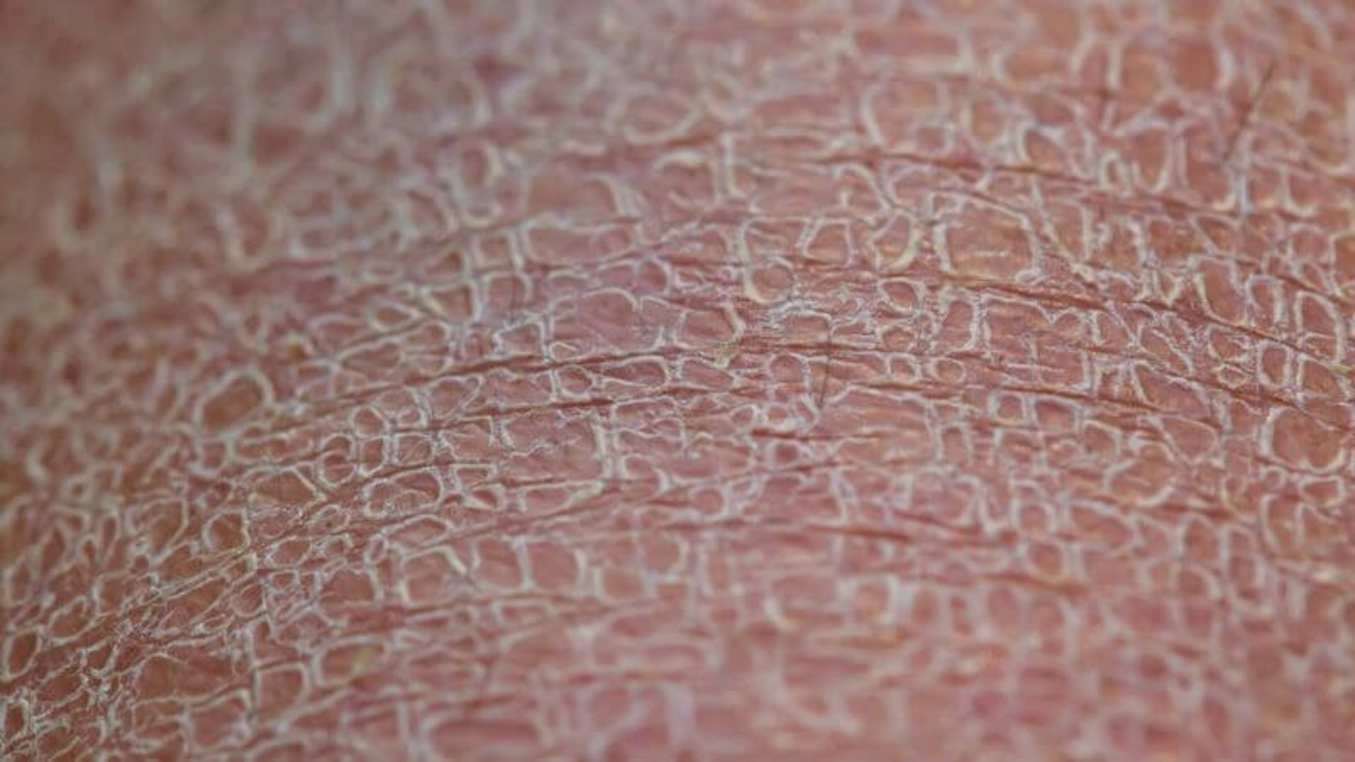 Da chân bị khô như da rắn khiến bề mặt sần sùi, bong vảy trắng, ngứa rát kéo dài
