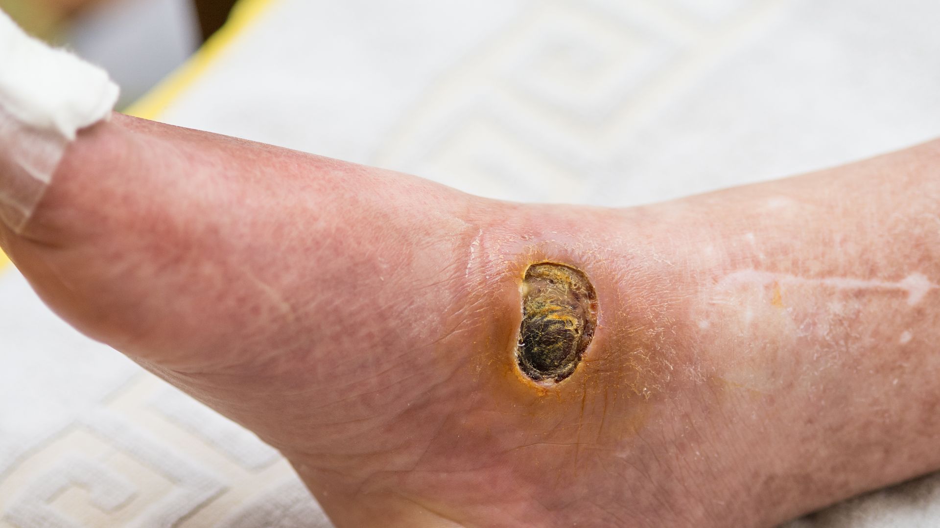 Da của người bị tiểu đường: Nhận biết các biểu hiện và cách chăm sóc hiệu quả 5