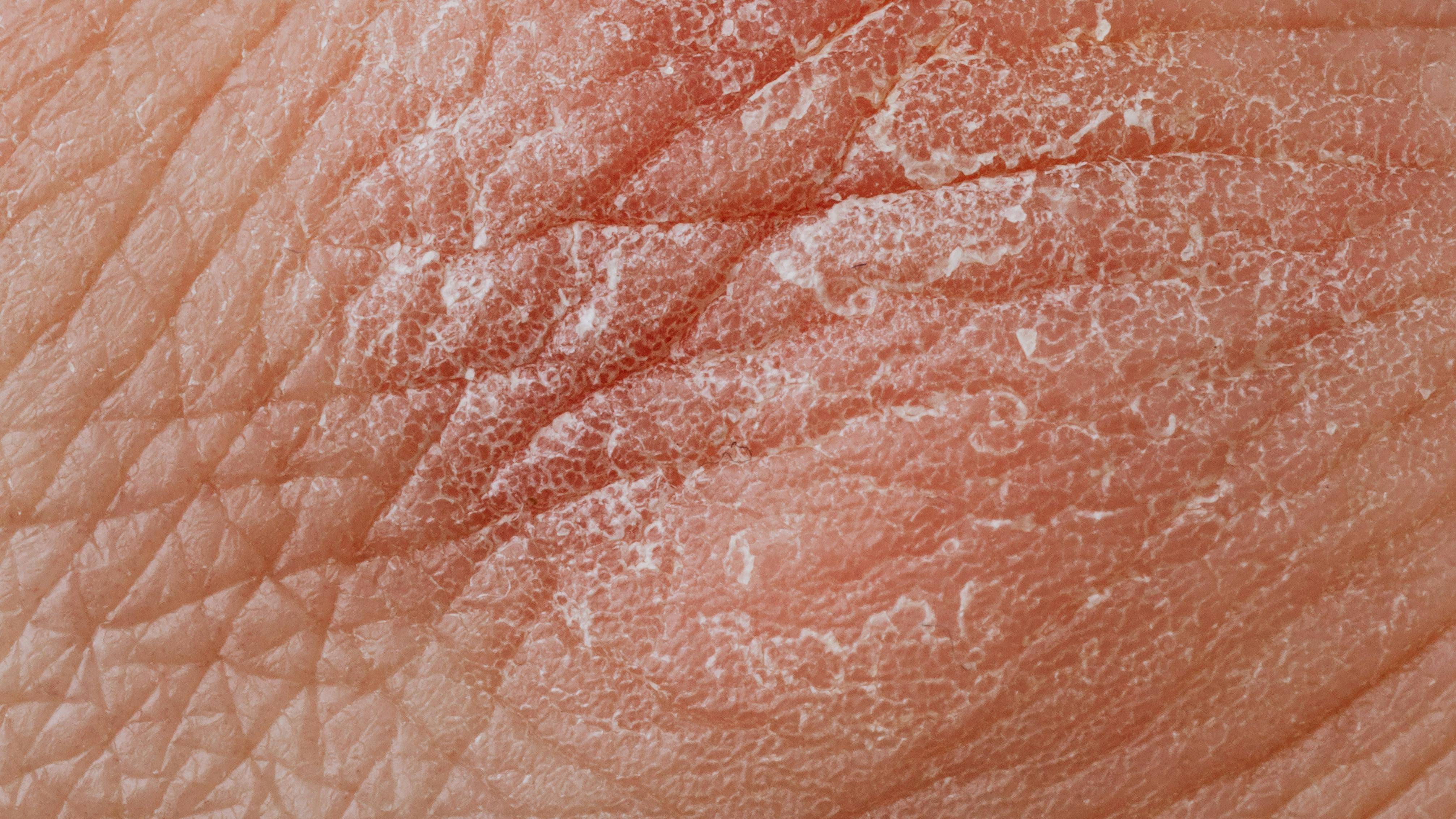 Da khô thiếu chất gì? Đó là nước vì nước chiếm tỷ lệ lớn trong cấu trúc tế bào da