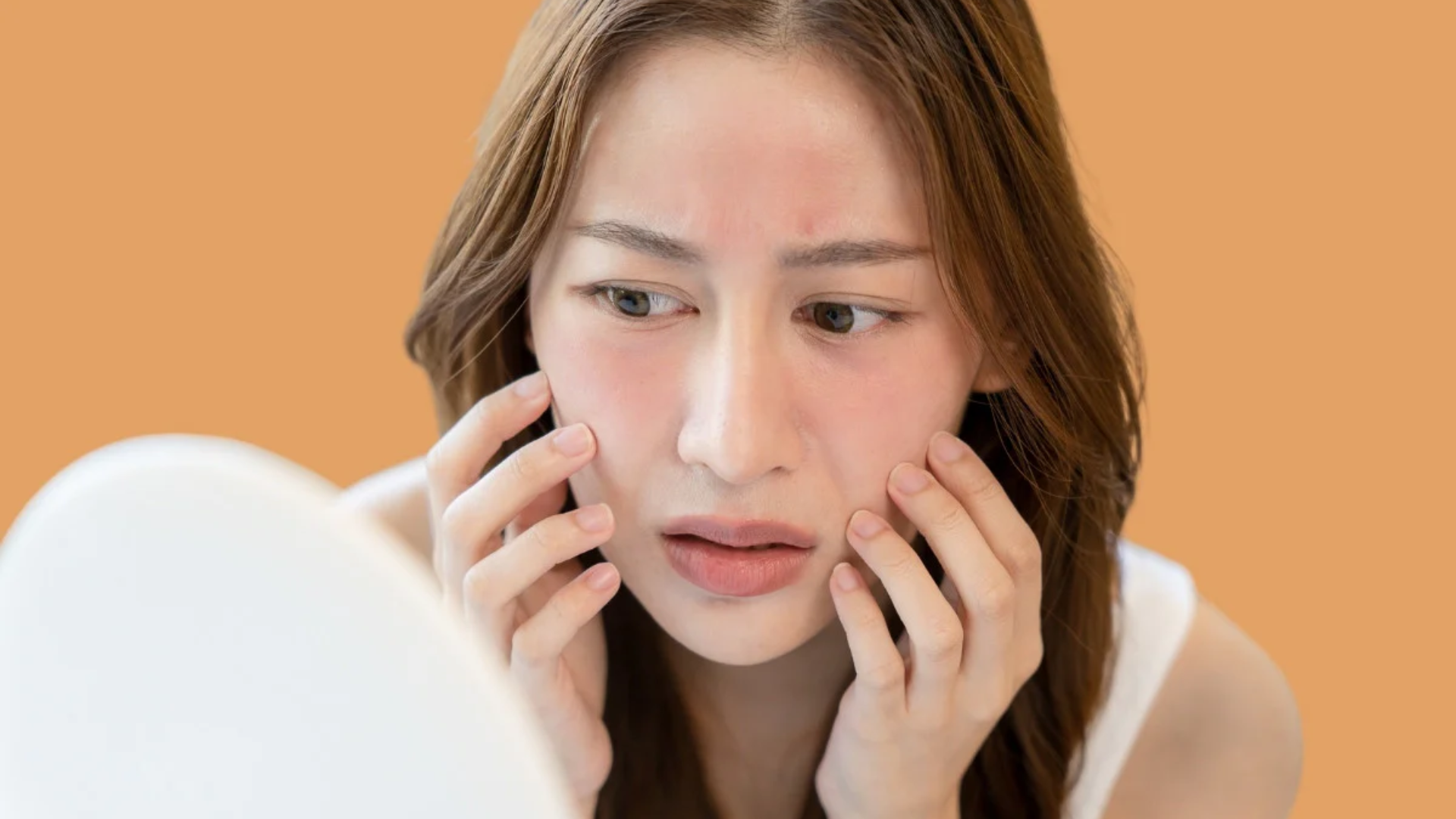 Hiện tượng da mỏng lộ mao mạch, gây vệt đỏ hồng tập trung ở nhiều vùng mặt