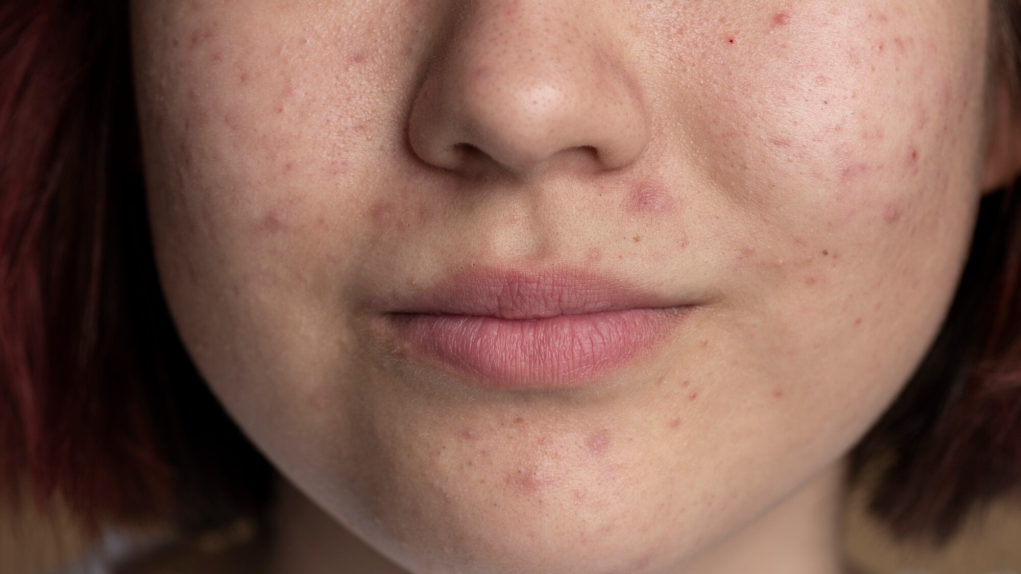 Da nhiễm corticoid là tình trạng làn da bị tổn thương do sử dụng các sản phẩm chứa corticoid trong thời gian dài