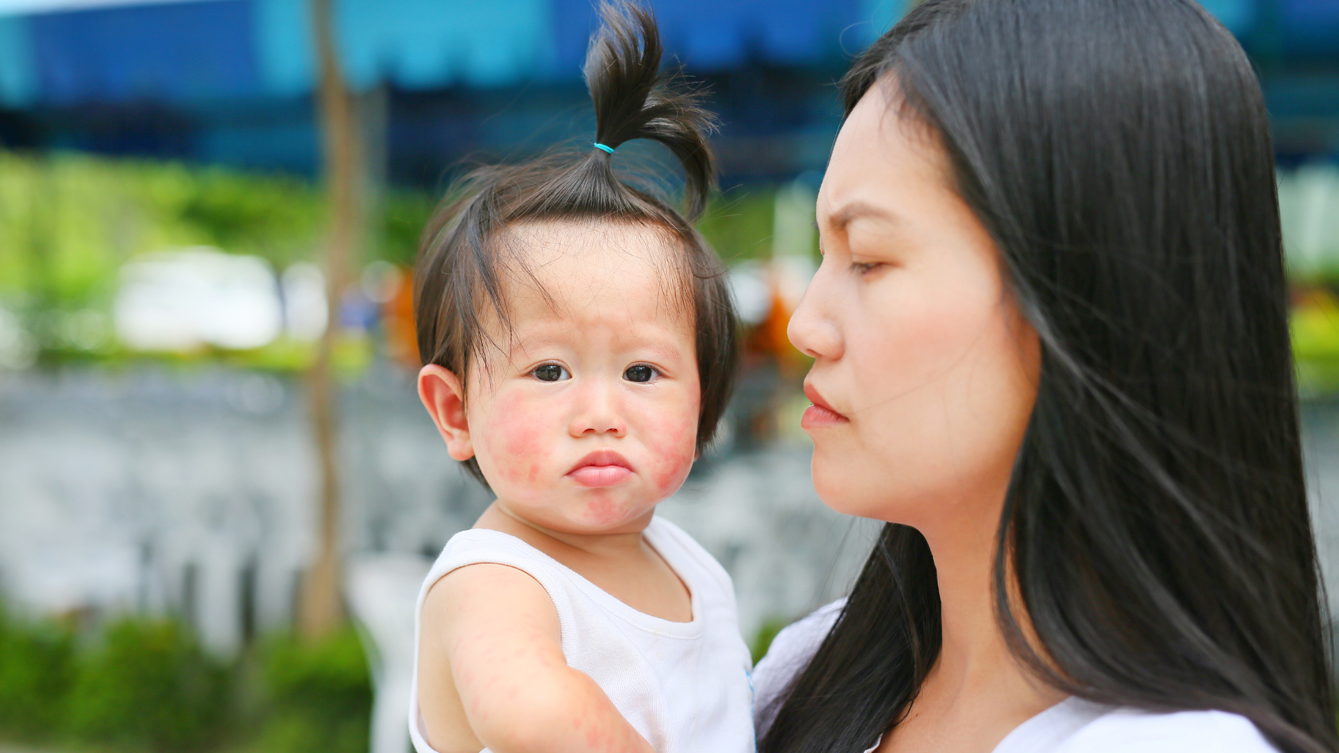 Sốt phát ban có thể làm da nổi ban đỏ như nốt ruồi son không bị ngứa