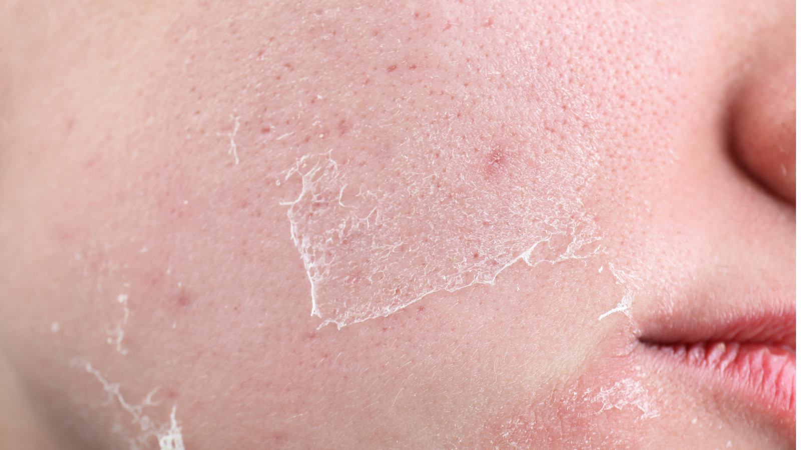 Da quá khô nguy cơ chàm khô cao hơn bình thường