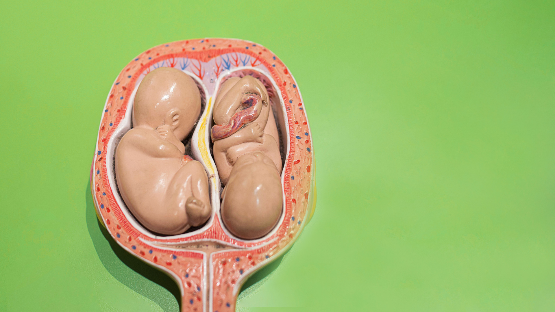 Đa thai là tình trạng có 2 thai trở lên phát triển trong thai kỳ