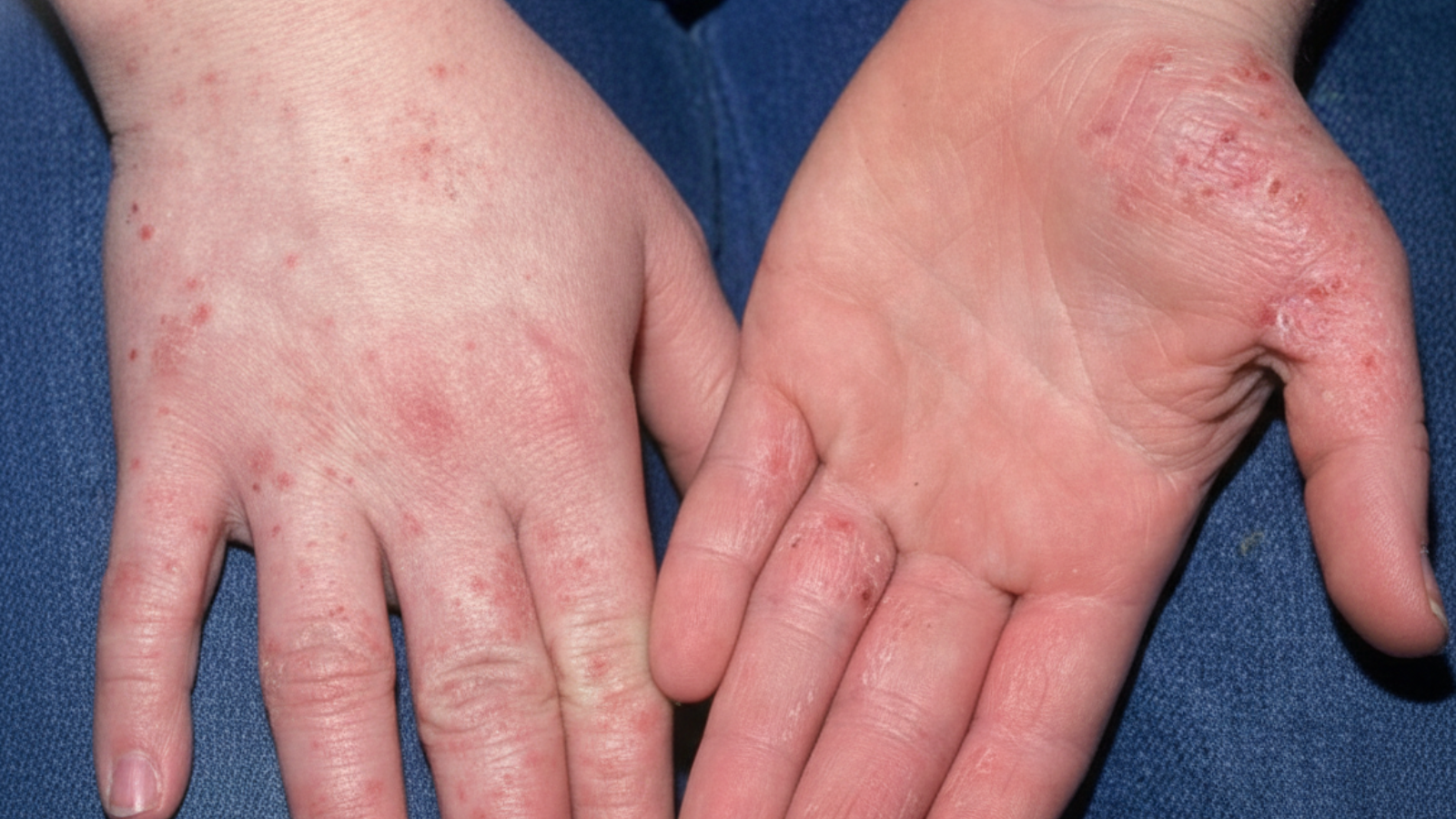 Da thô ráp, tối màu do tổ đỉa kéo dài không điều trị đúng cách