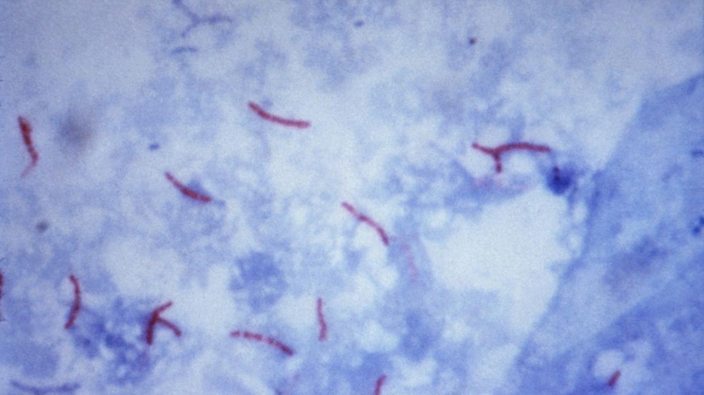 dac-diem-cua-vi-khuan-lao-va-cach-phong-ngua-hieu-qua 5.jpg