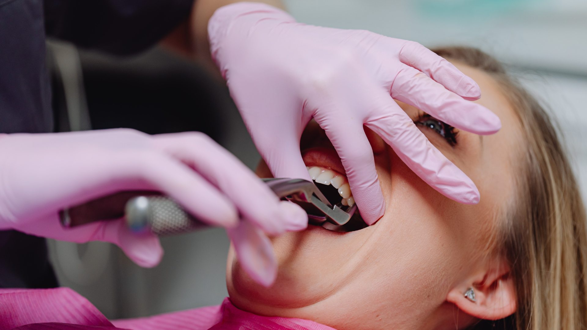 Đang cho con bú có nhổ răng khôn được không?