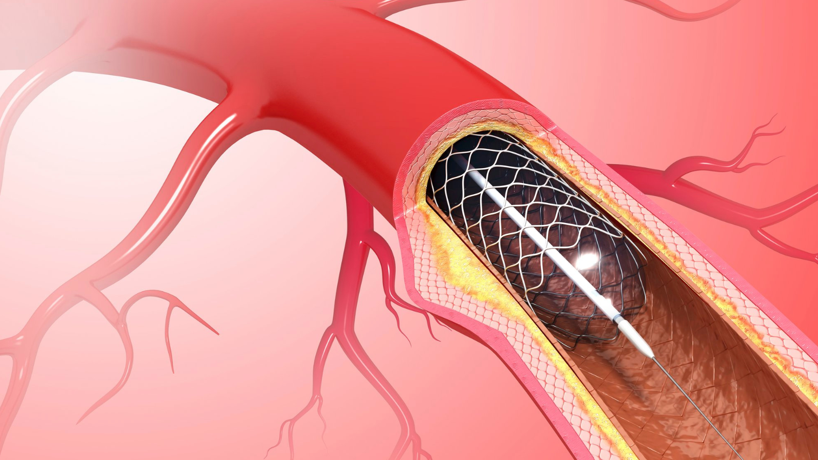 Đặt stent tim được chỉ định trong trường hợp nào?