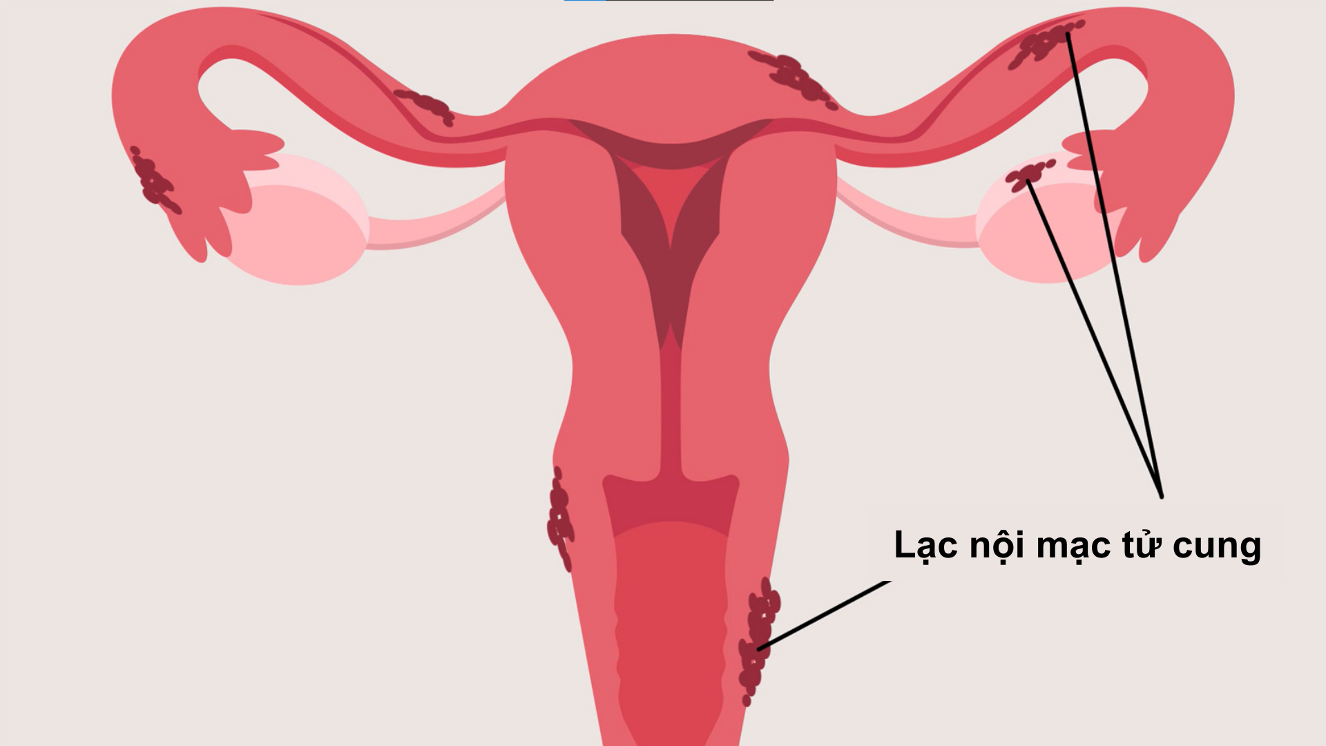 Đau bụng dưới: Nguyên nhân, triệu chứng và phương pháp điều trị 3