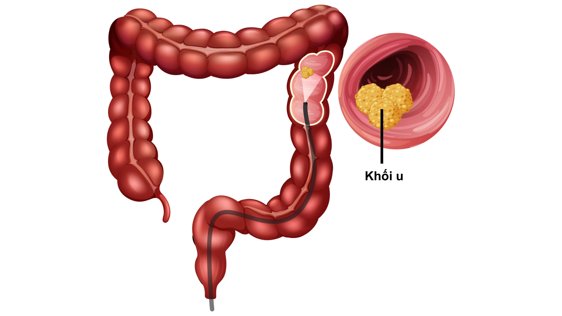 Đau bụng dưới: Nguyên nhân, triệu chứng và phương pháp điều trị 5