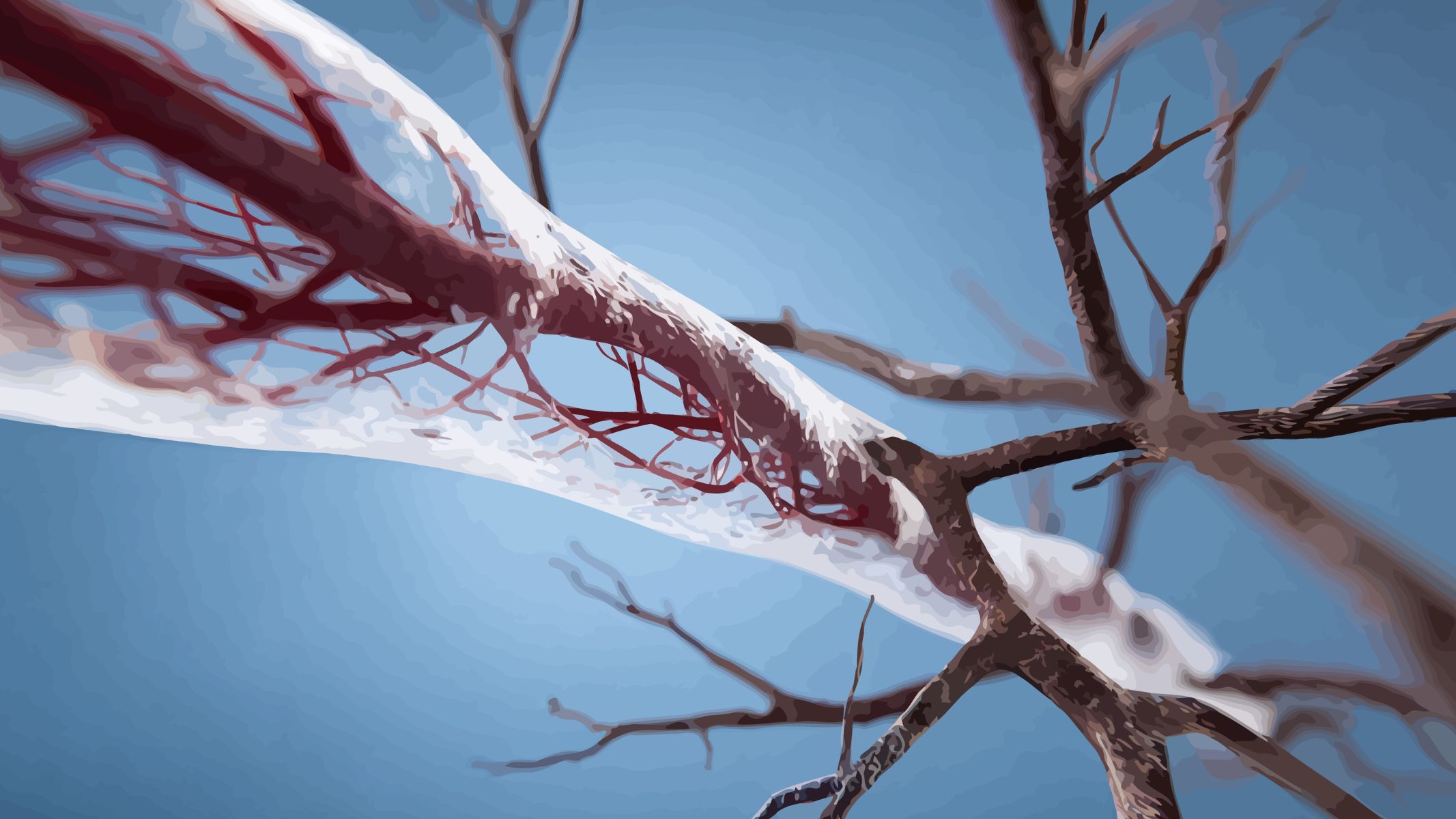 Chèn ép mạch máu nội sọ là nguyên nhân phổ biến nhất gây đau dây thần kinh