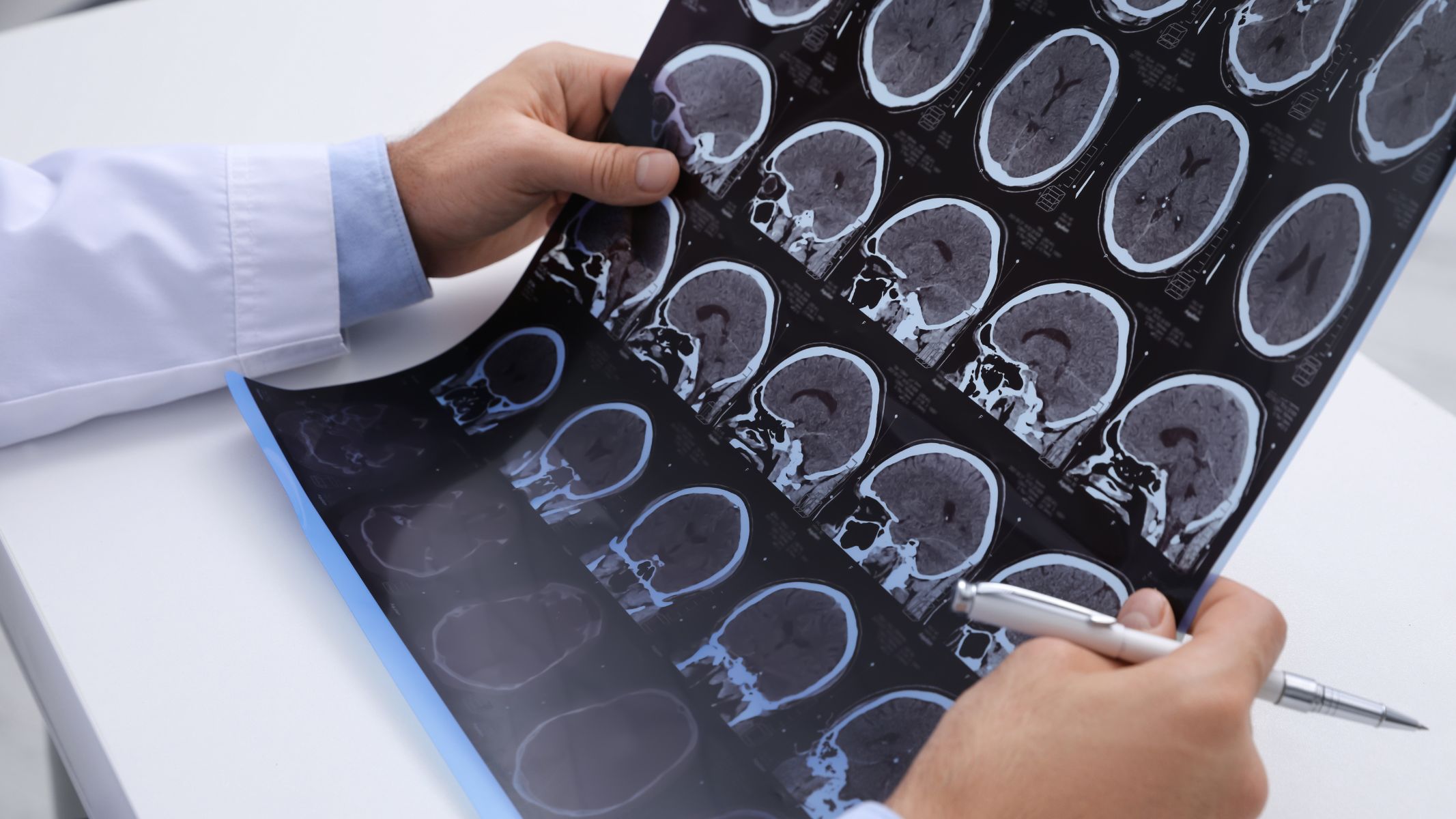 Đa xơ cứng là bệnh lý tự miễn gây mất myelin trong hệ thần kinh trung ương