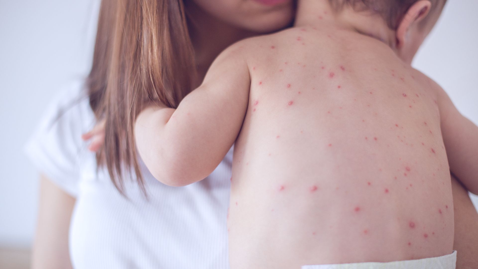 Dấu hiệu bệnh sởi ở trẻ dưới 1 tuổi-2