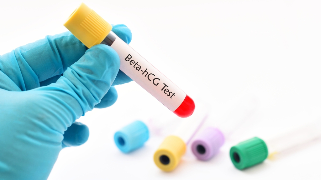 IUI chỉ được xác định thành công qua xét nghiệm beta-hCG sau khoảng 14 ngày