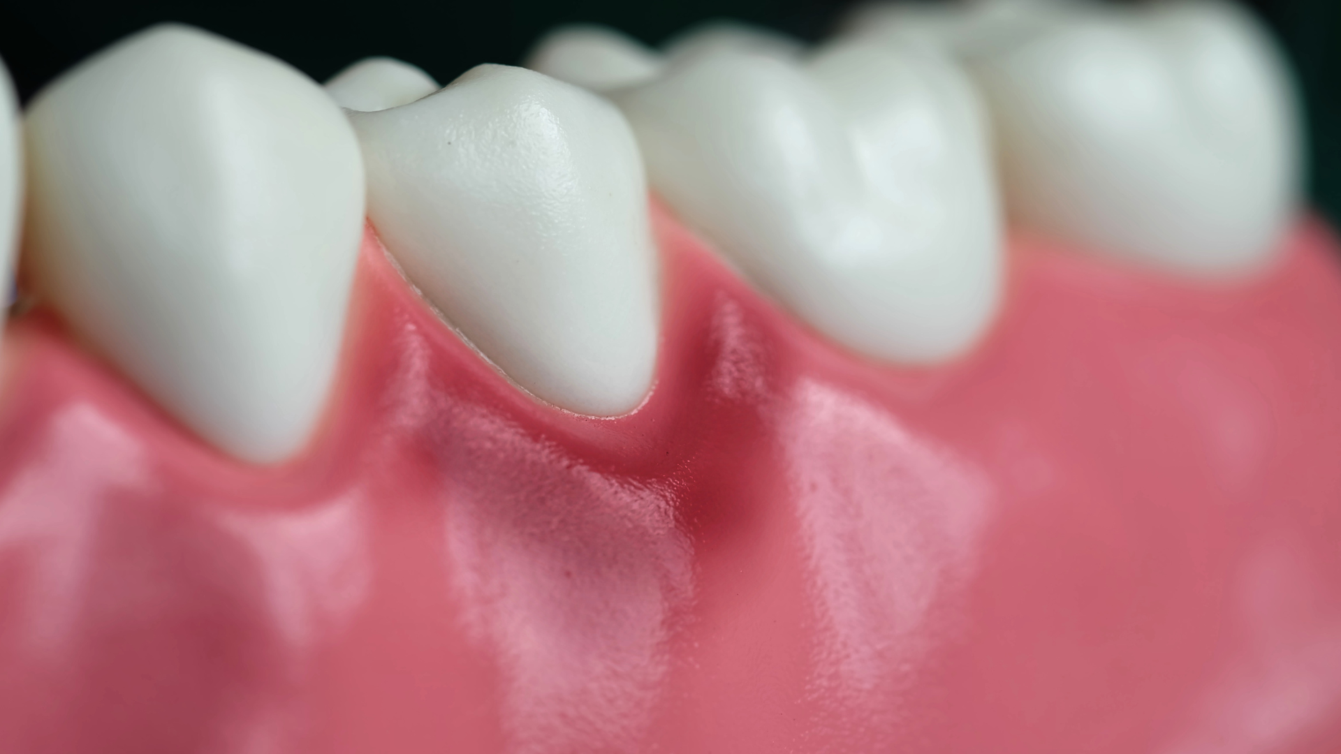 Thận trọng khi thấy nướu sưng đỏ, dễ chảy máu