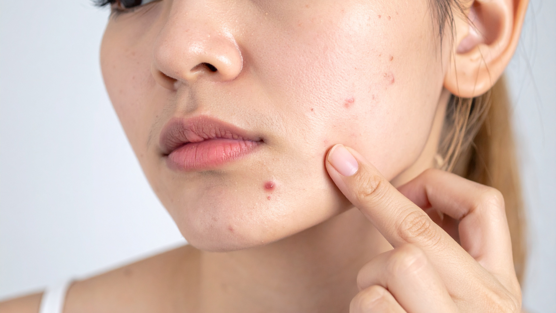 Nổi mụn cũng là một trong những dấu hiệu báo sắp đến ngày hành kinh