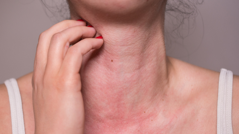 Dấu hiệu dị ứng: Nhận biết sớm và xử lý đúng cách tránh biến chứng 2