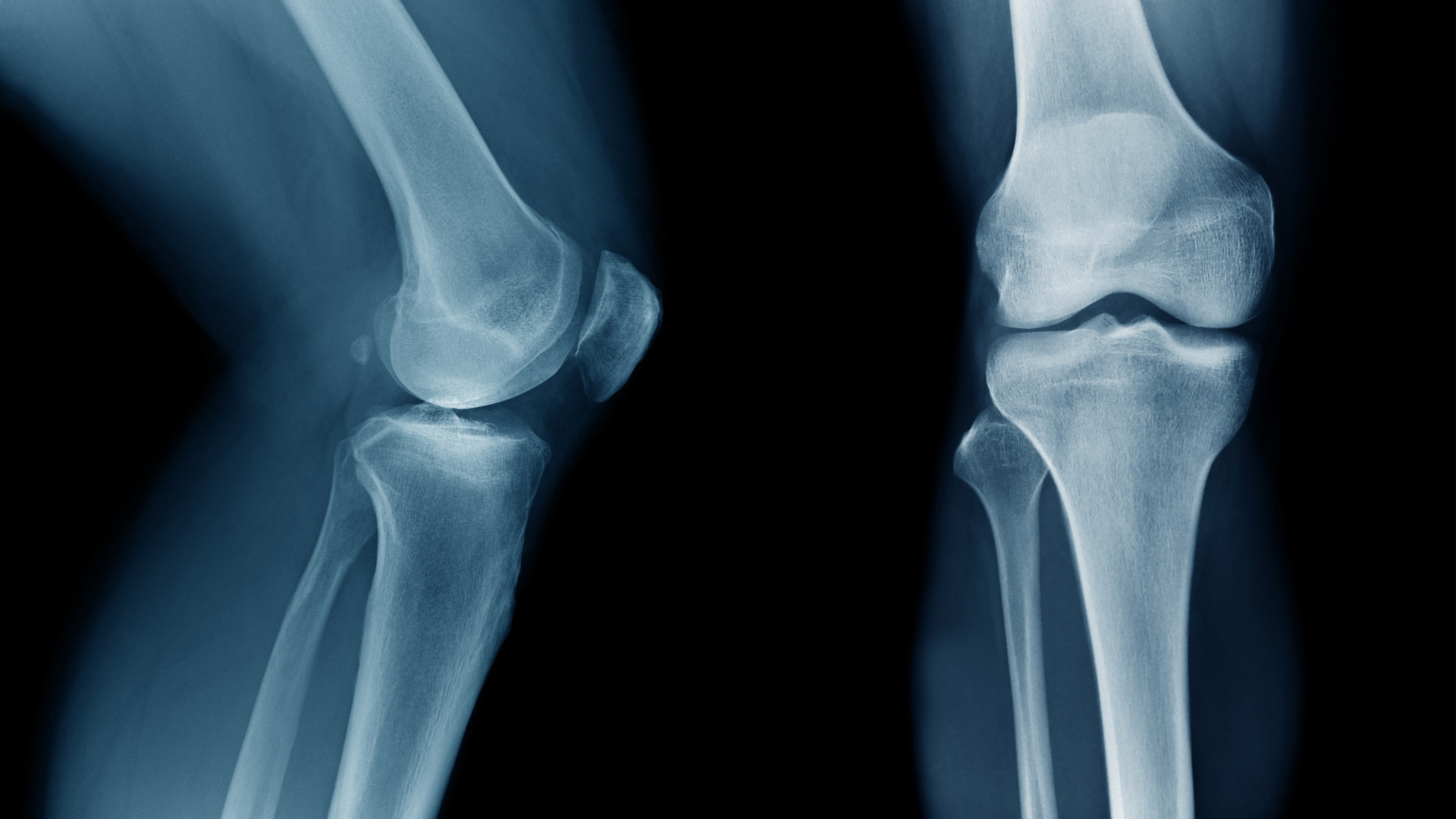 Chụp X-quang là phương pháp phổ biến, giúp xác định vị trí gãy