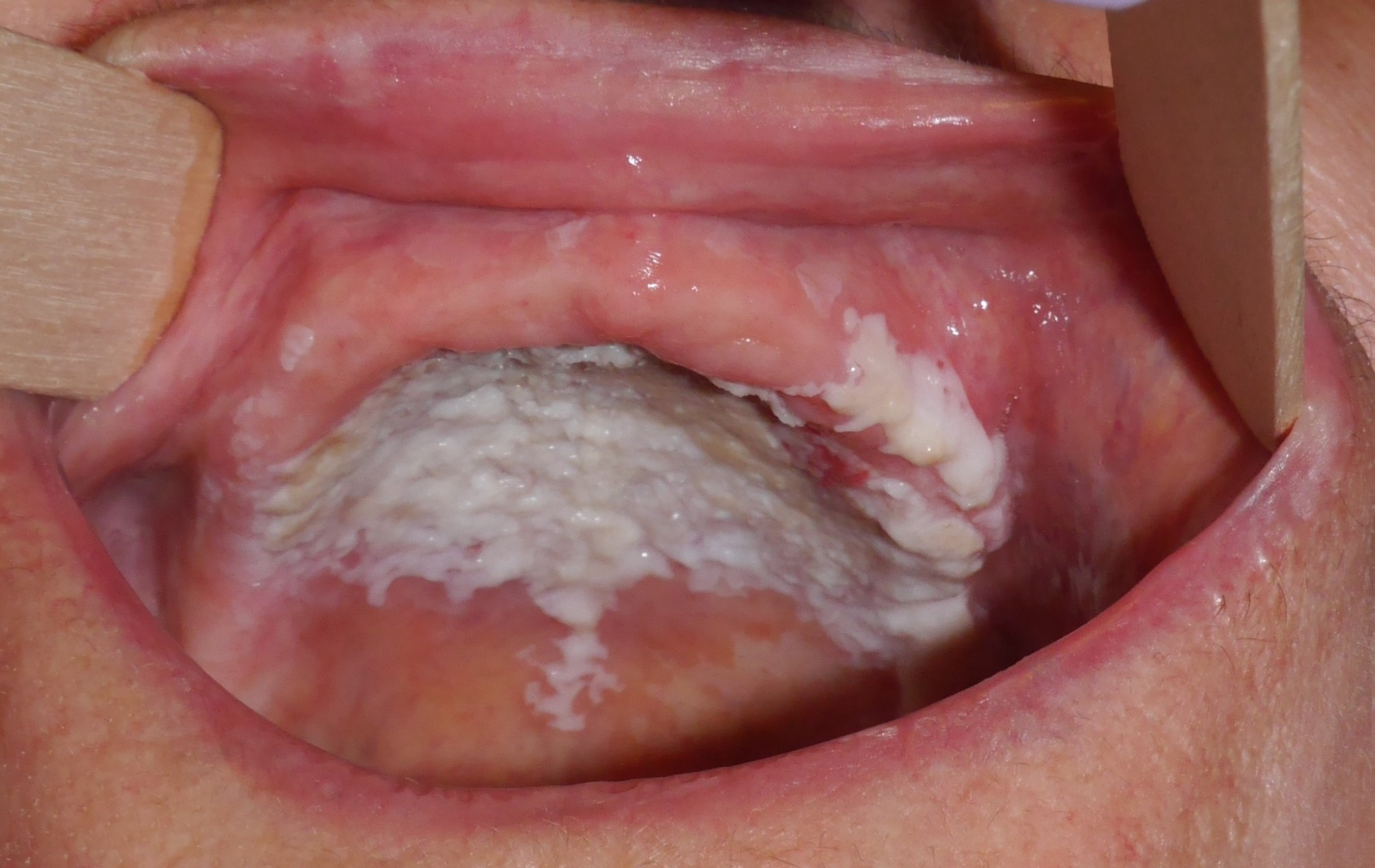 Dấu hiệu HIV ở miệng và những điều cần biết 1