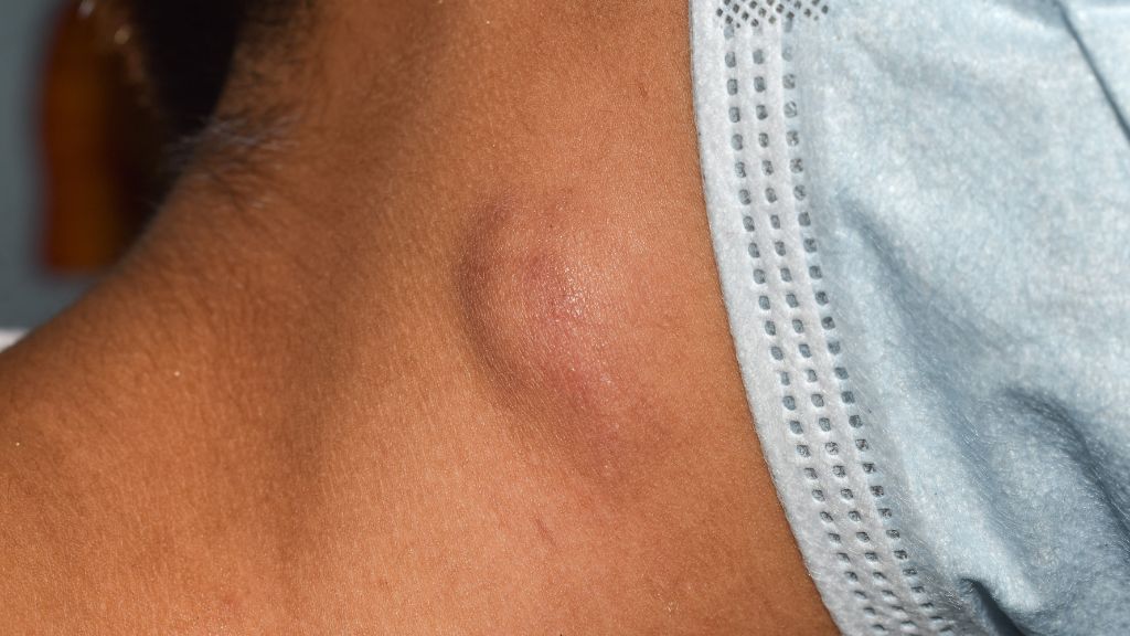 Dấu hiệu HIV và những thông tin liên quan về bệnh cần nắm! 5