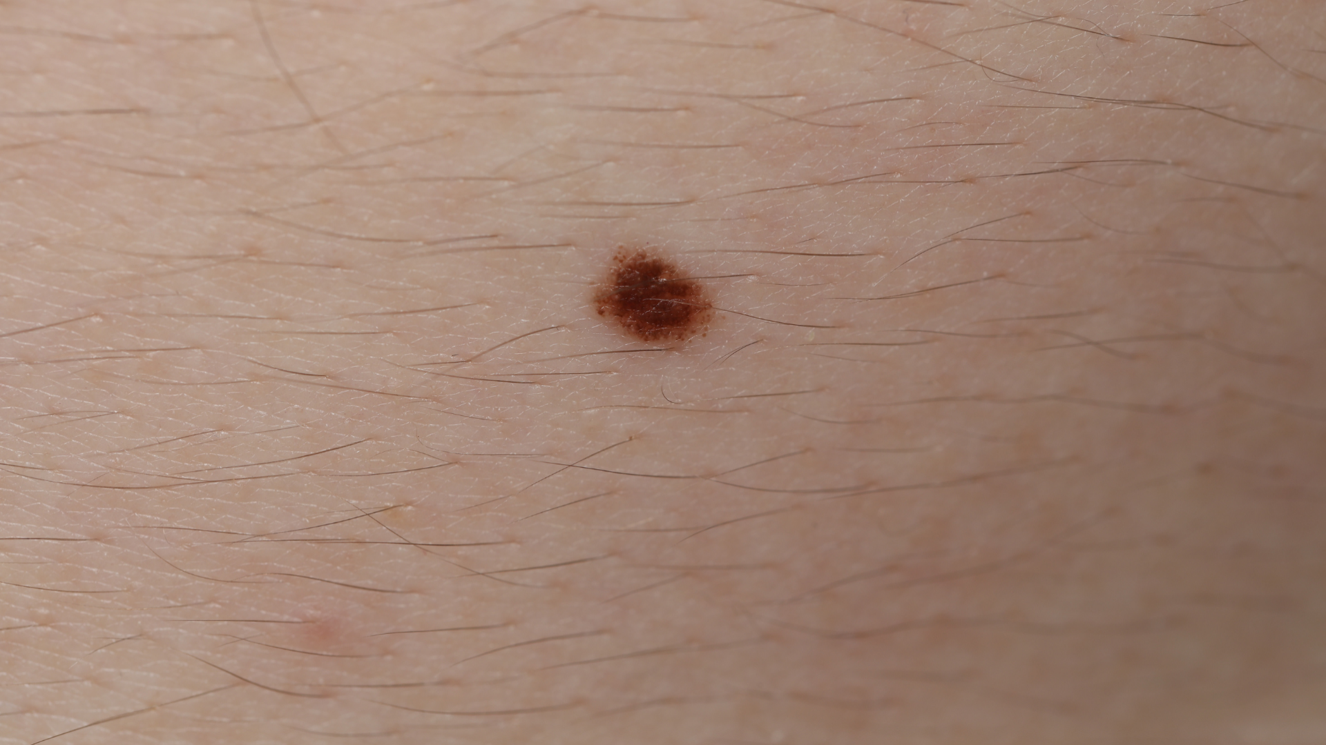 Nốt ruồi thay đổi màu sắc, kích thước, bờ không đều hoặc chảy máu là một trong những biểu hiện của u ác tính