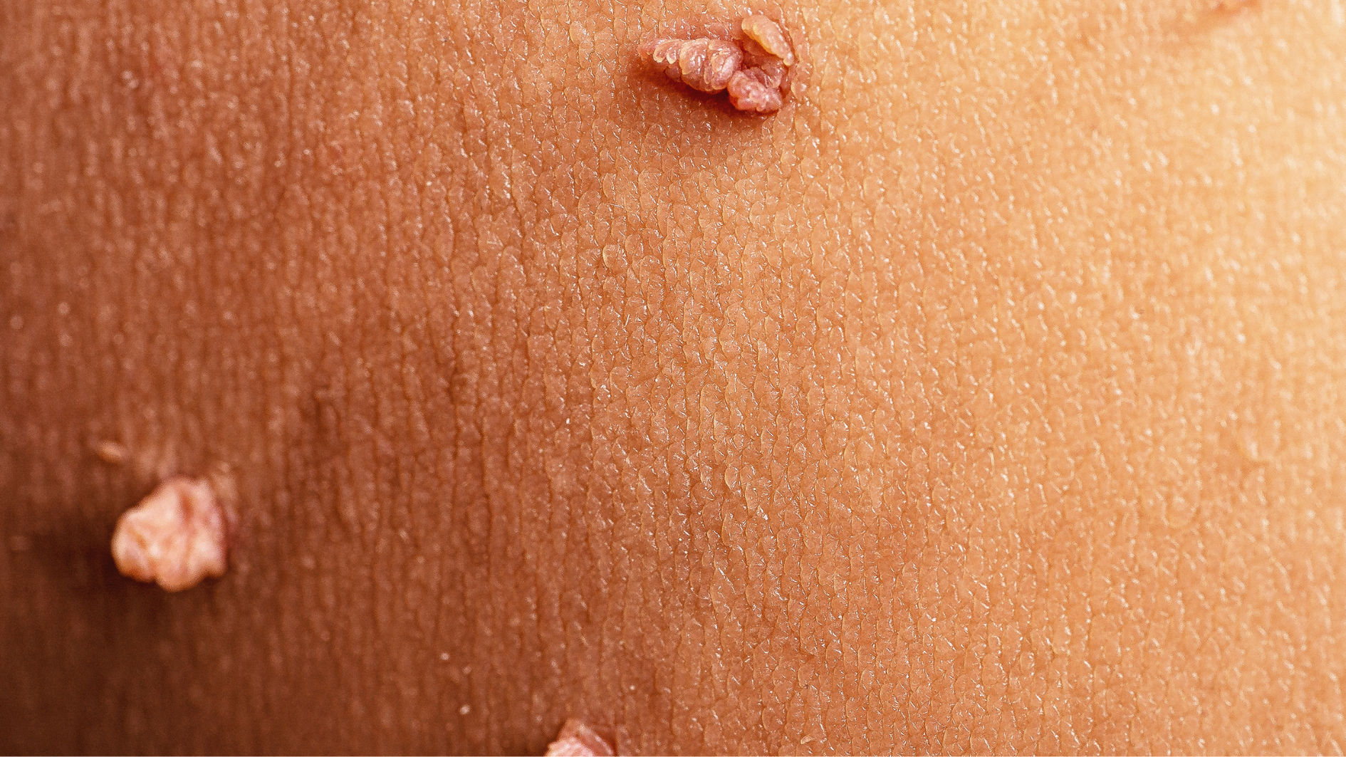 dau-hieu-nhiem-hpv-ban-nen-biet (1).png