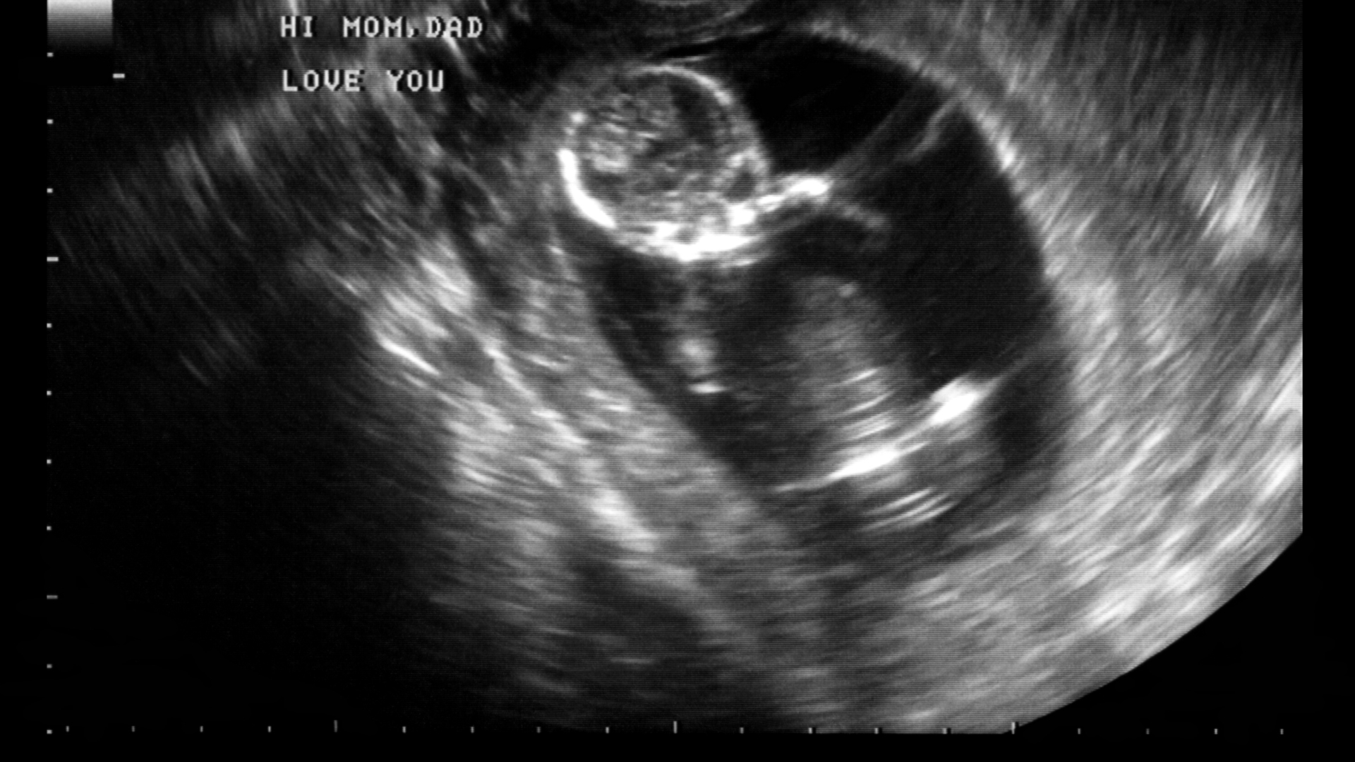 Rỉ nối nếu không được can thiệp kịp thời có thể dẫn đến nhiều hệ lụy nghiêm trọng với thau nhi