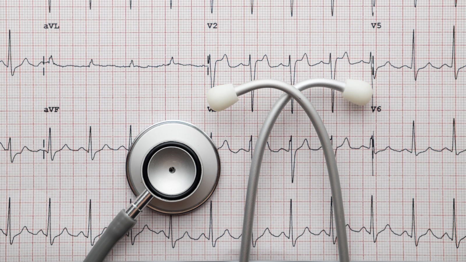 Điện tâm đồ là xét nghiệm tiêu chuẩn giúp ghi lại hoạt động điện của tim trong vài giây