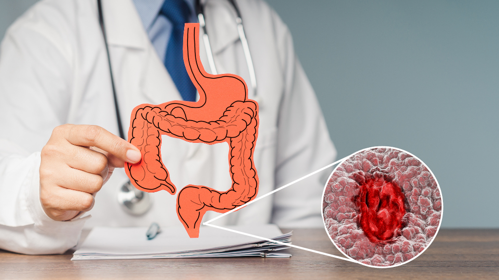 Ung thư hậu môn là một căn bệnh hiếm gặp nhưng có xu hướng gia tăng trong những năm gần đây