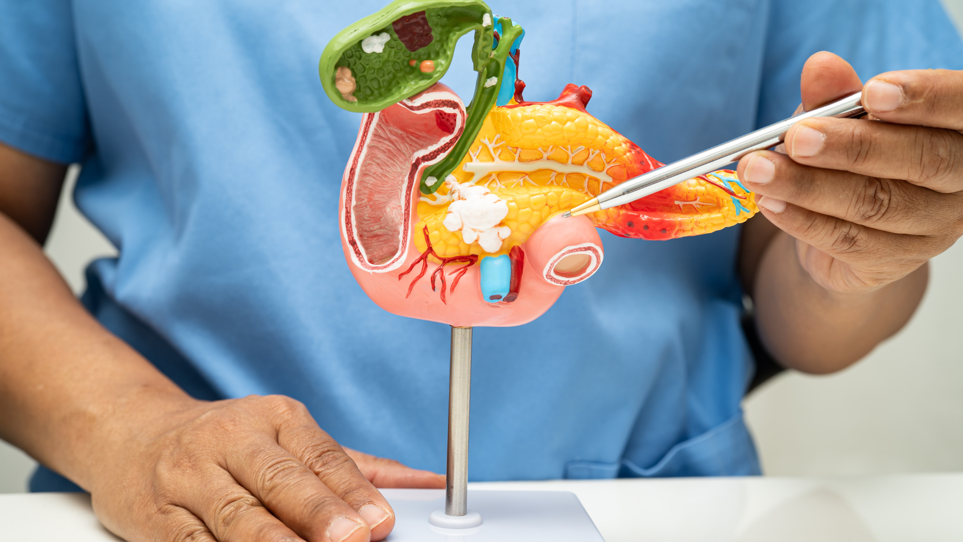 Ung thư tuyến tụy là tình trạng các tế bào trong tuyến tụy phát triển bất thường