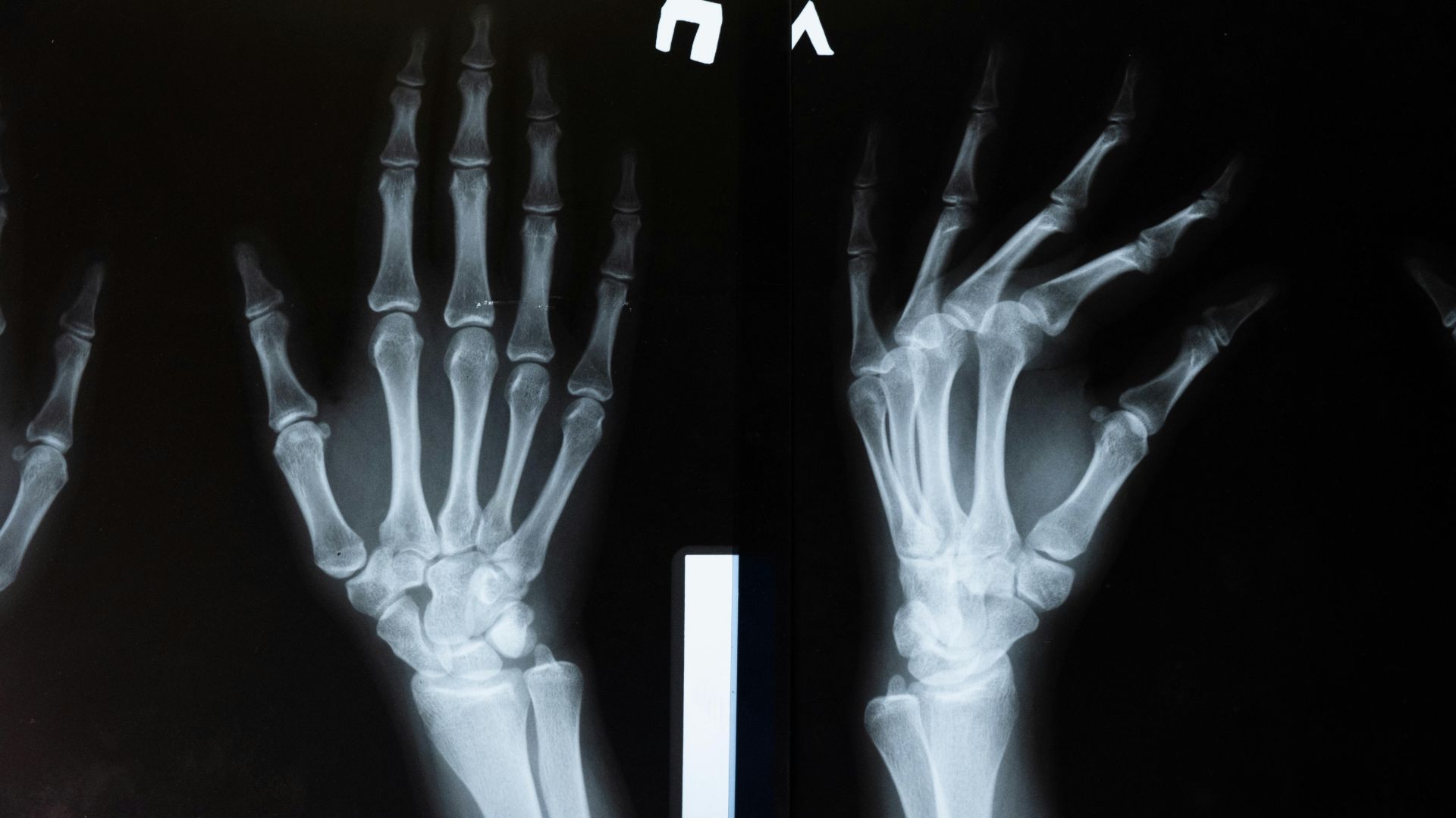 Chụp X-quang là công cụ chẩn đoán hình ảnh đầu tay, nhanh chóng và tiết kiệm chi phí