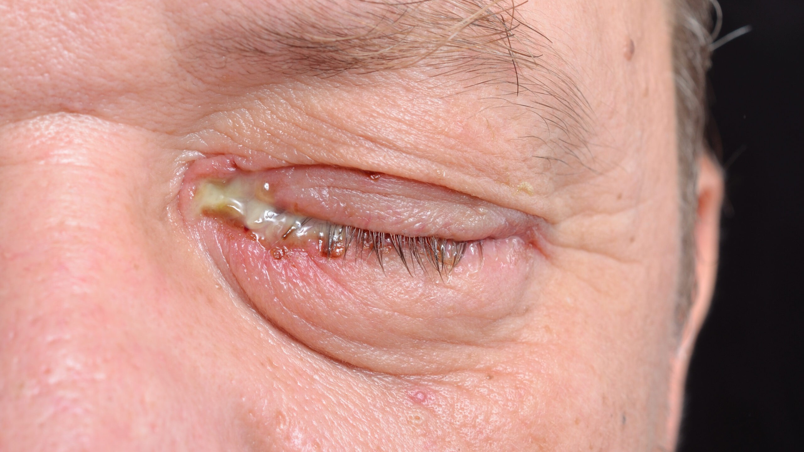 Đau mắt đỏ có thể gây tiết dịch đặc ở mắt