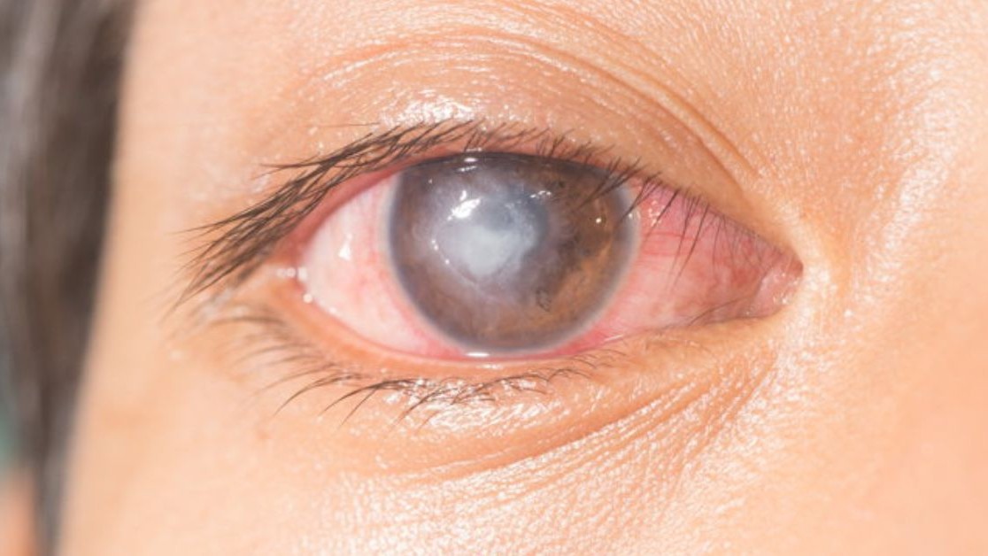 Đau mắt đỏ nếu không được điều trị đúng cách có thể dẫn đến biến chứng viêm loét giác mạc ảnh hưởng thị lực