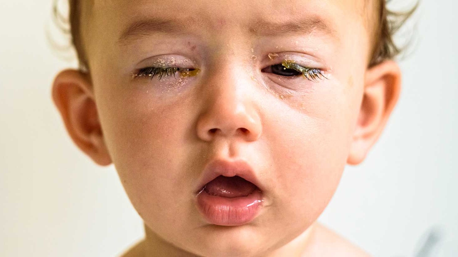 Trẻ em là đối tượng dễ mắc bệnh đau mắt đỏ