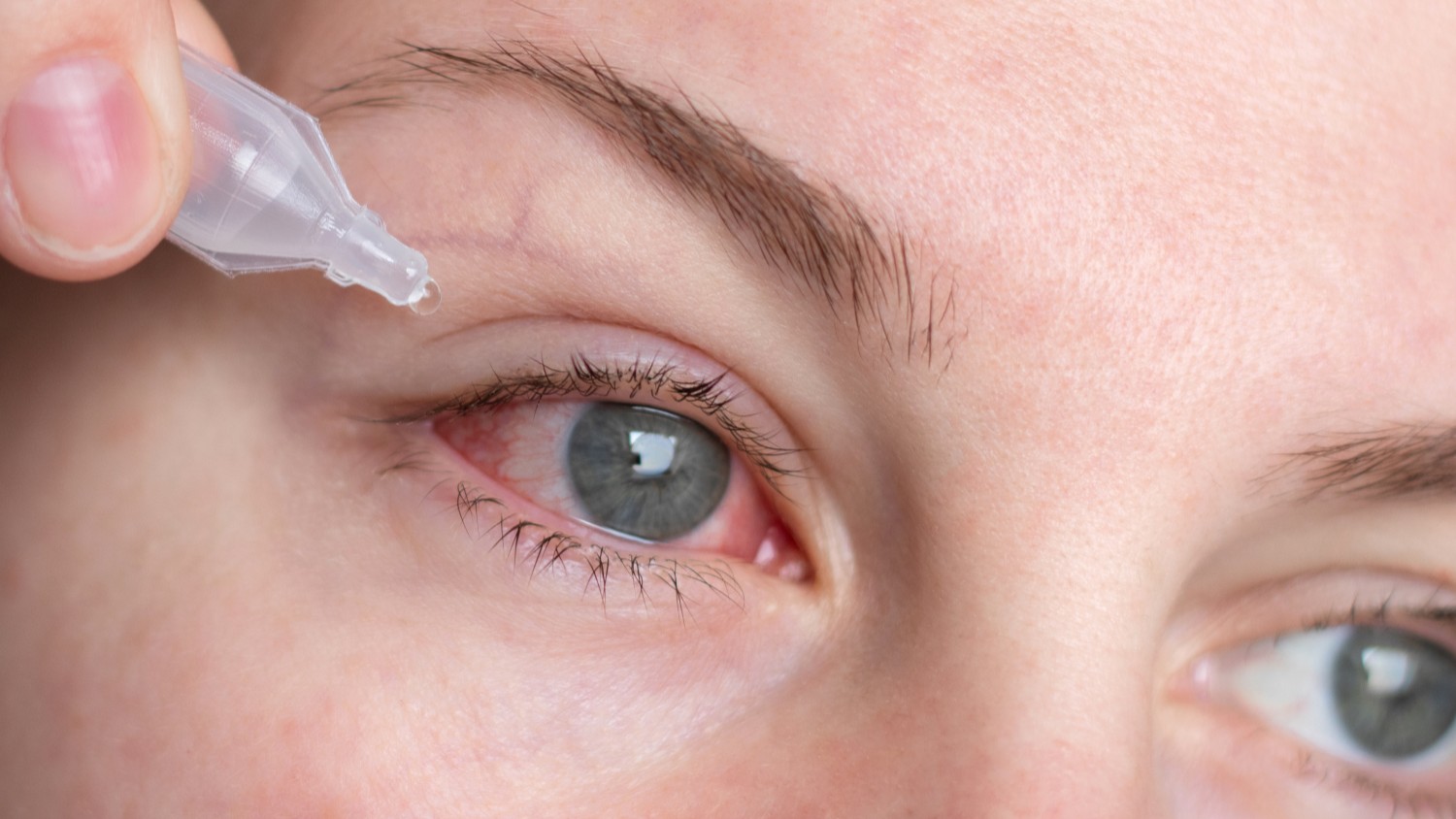 Bạn có thể dùng nước mắt nhân tạo để làm dịu và giữ ẩm cho mắt