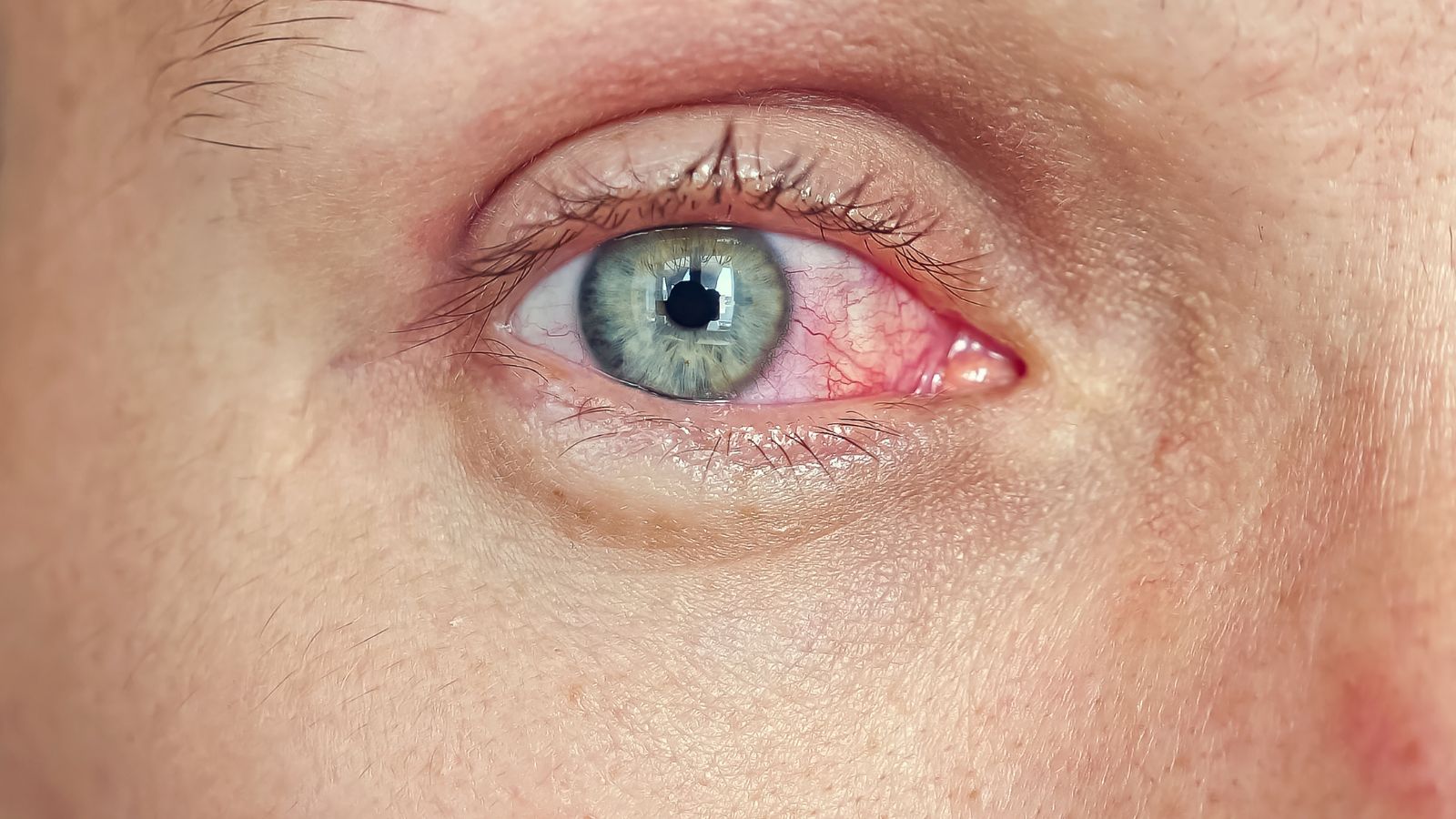 Có nhiều nguyên nhân gây đau mắt đỏ