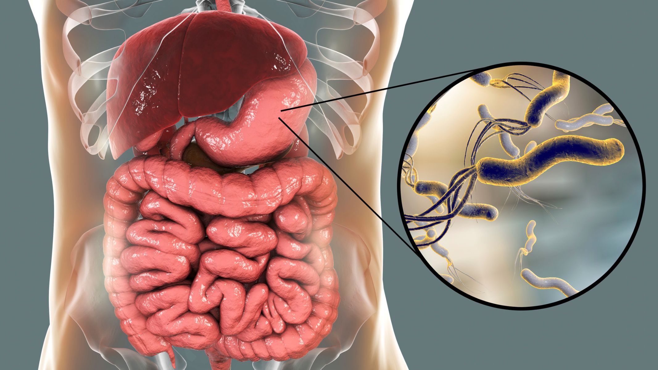 Dạ dày nhiễm vi khuẩn Helicobacter pylori có thể làm tăng nguy cơ loét dạ dày