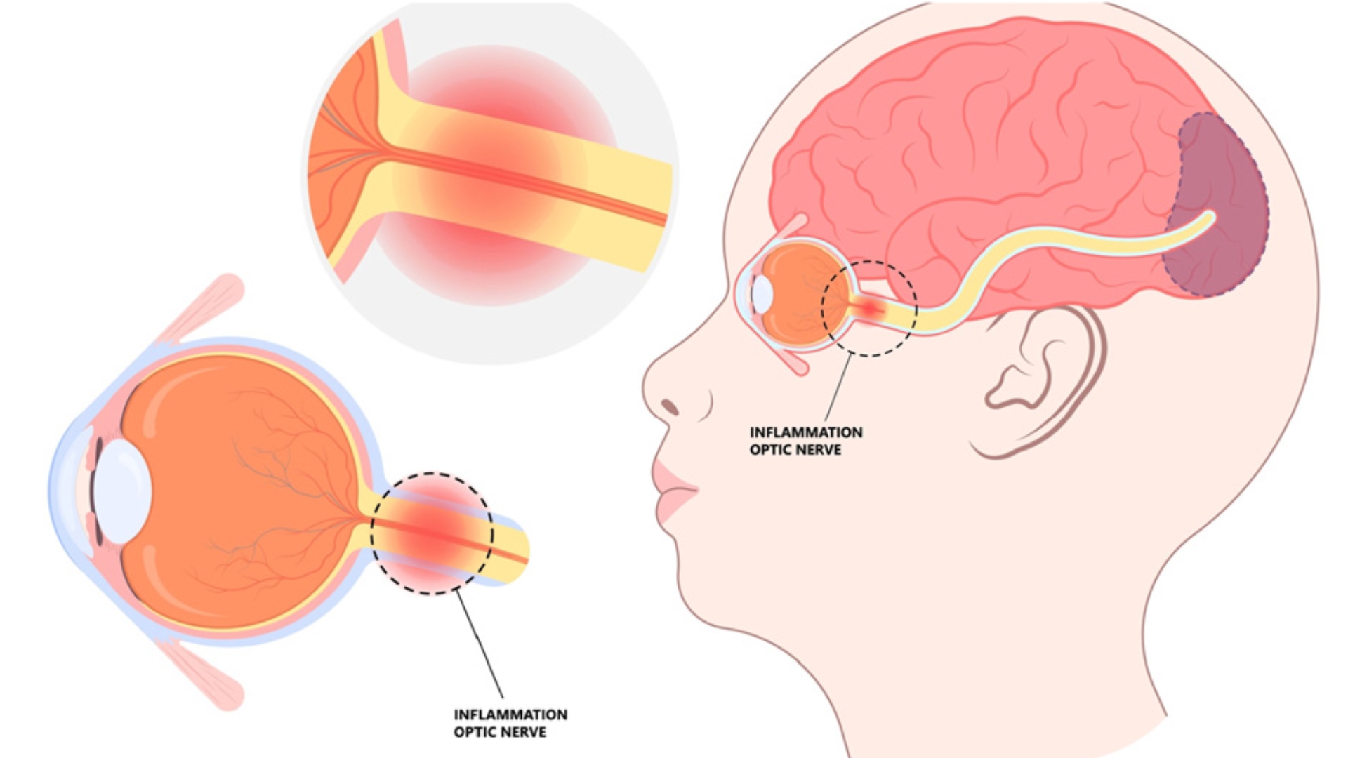 Viêm dây thần kinh thị giác là tình trạng sợi thần kinh bị tổn thương do viêm hoặc nhiễm trùng