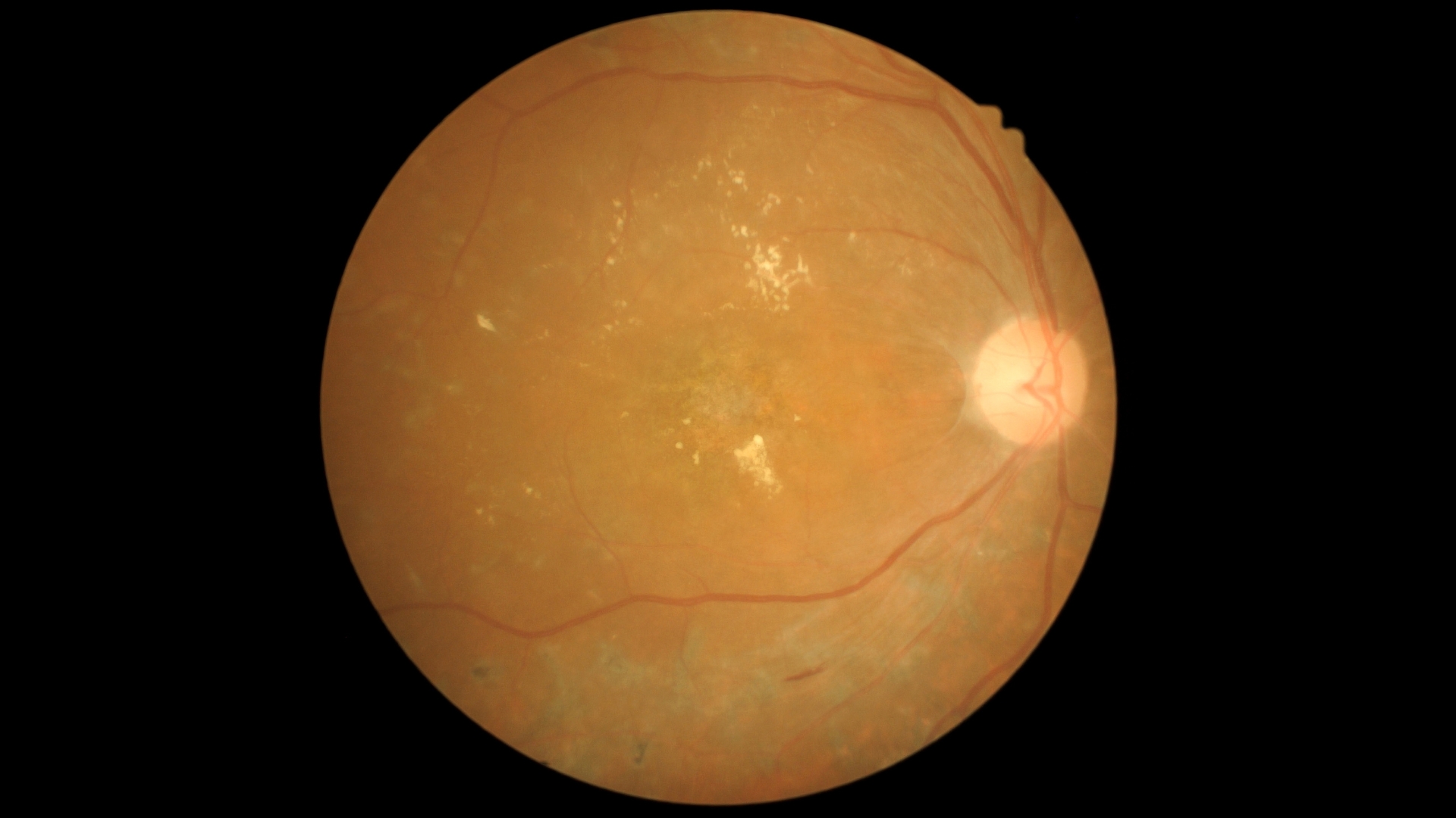 Teo dây thần kinh thị giác là hậu quả của tổn thương kéo dài, khiến các sợi thần kinh mất dần chức năng và thoái hóa