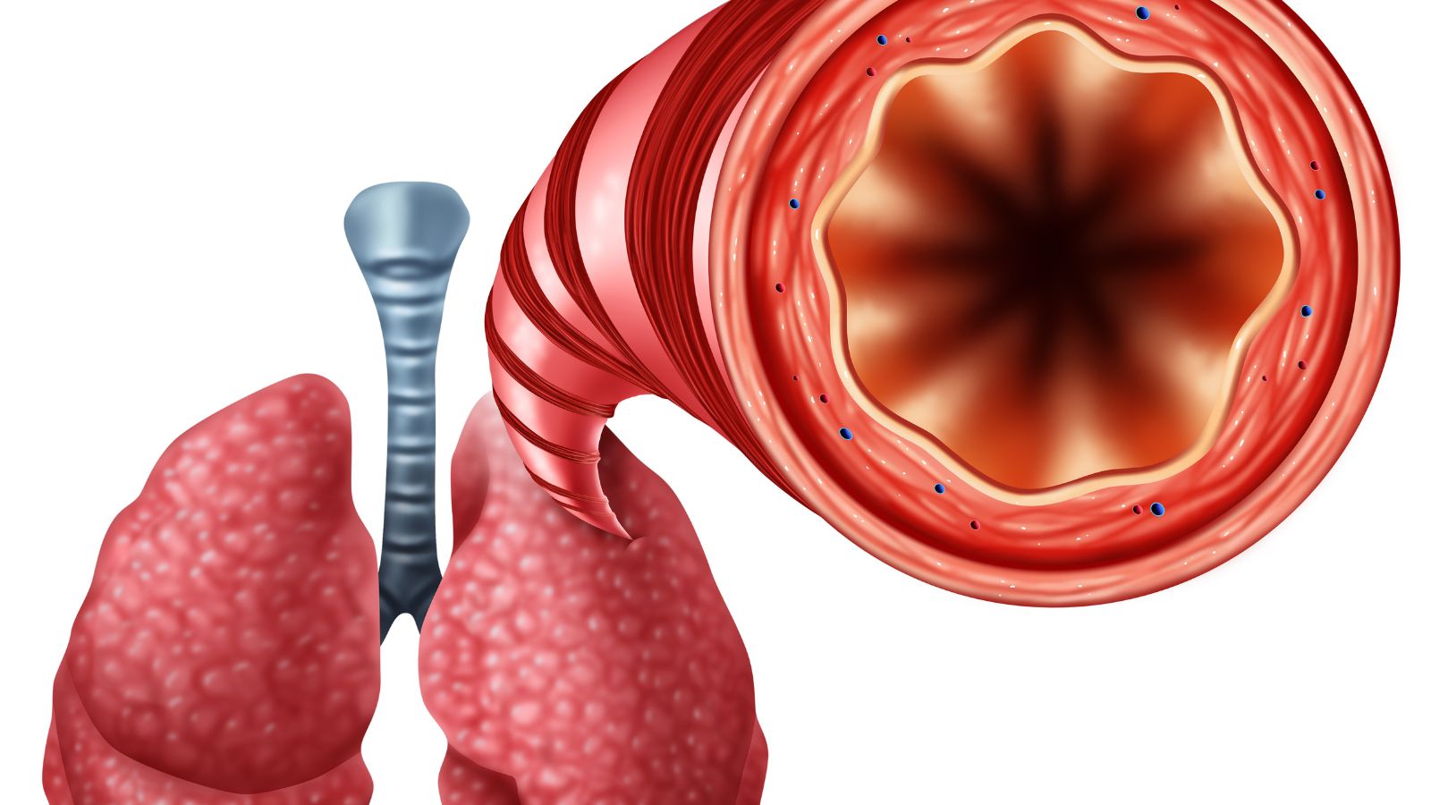 Triệu chứng của dày thành phế quản khá đa dạng