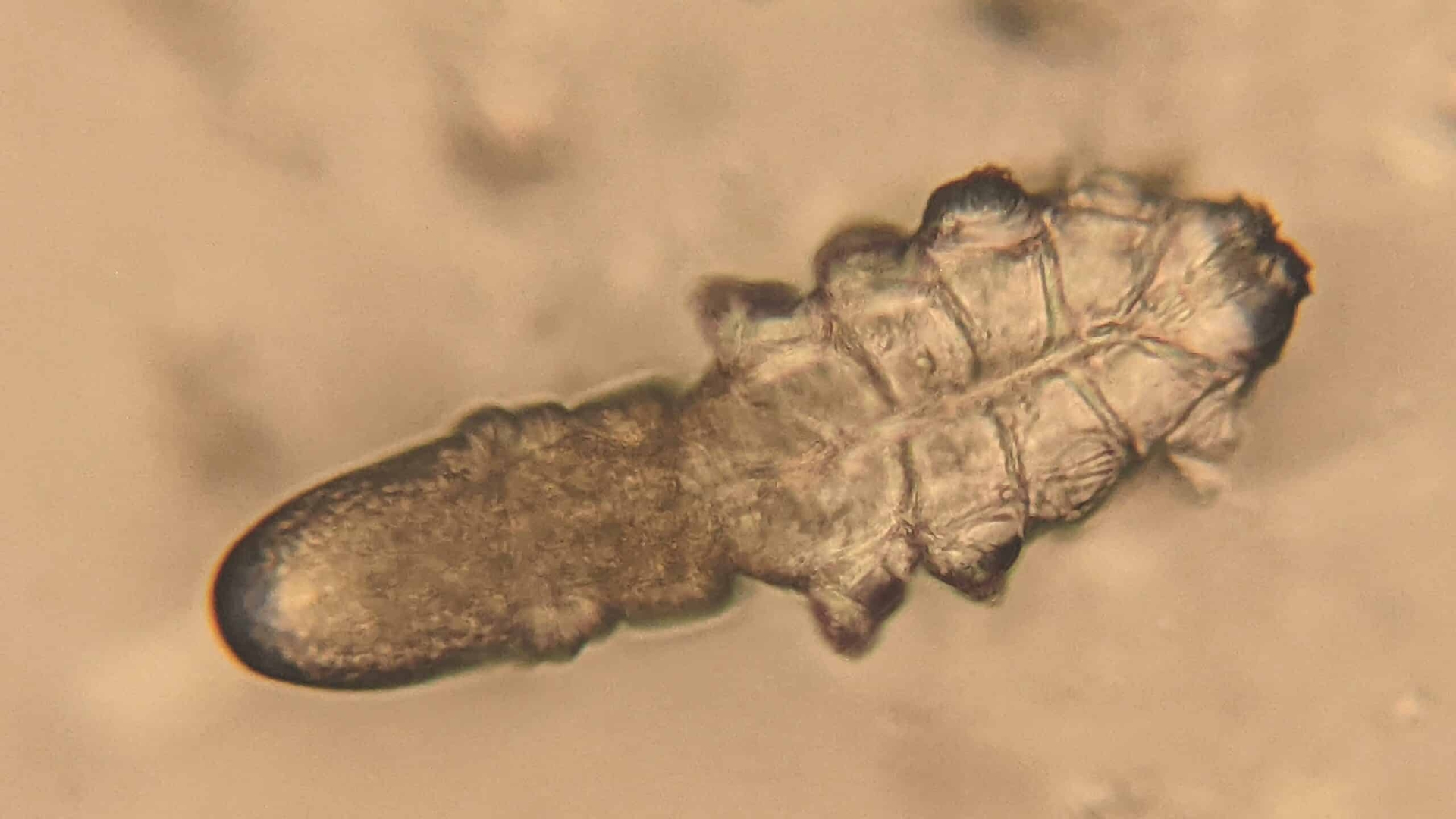 Mật độ Demodex được xem là bất thường khi có trên năm cá thể trong mỗi centimet vuông da