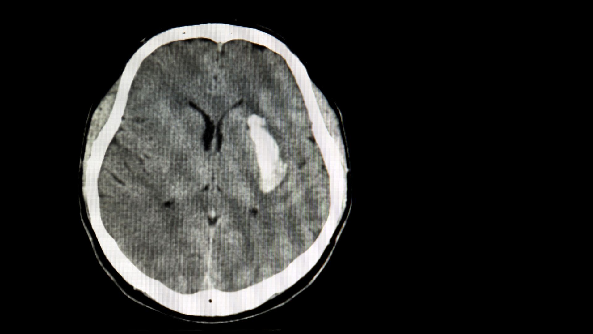 Xuất huyết não là biến chứng hay gặp ở dị dạng động – tĩnh mạch