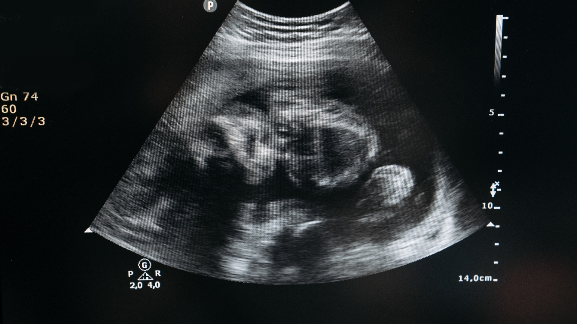 Khó thụ thai hoặc ngôi thai bất thường có thể do cấu trúc tử cung bất thường ở người mẹ