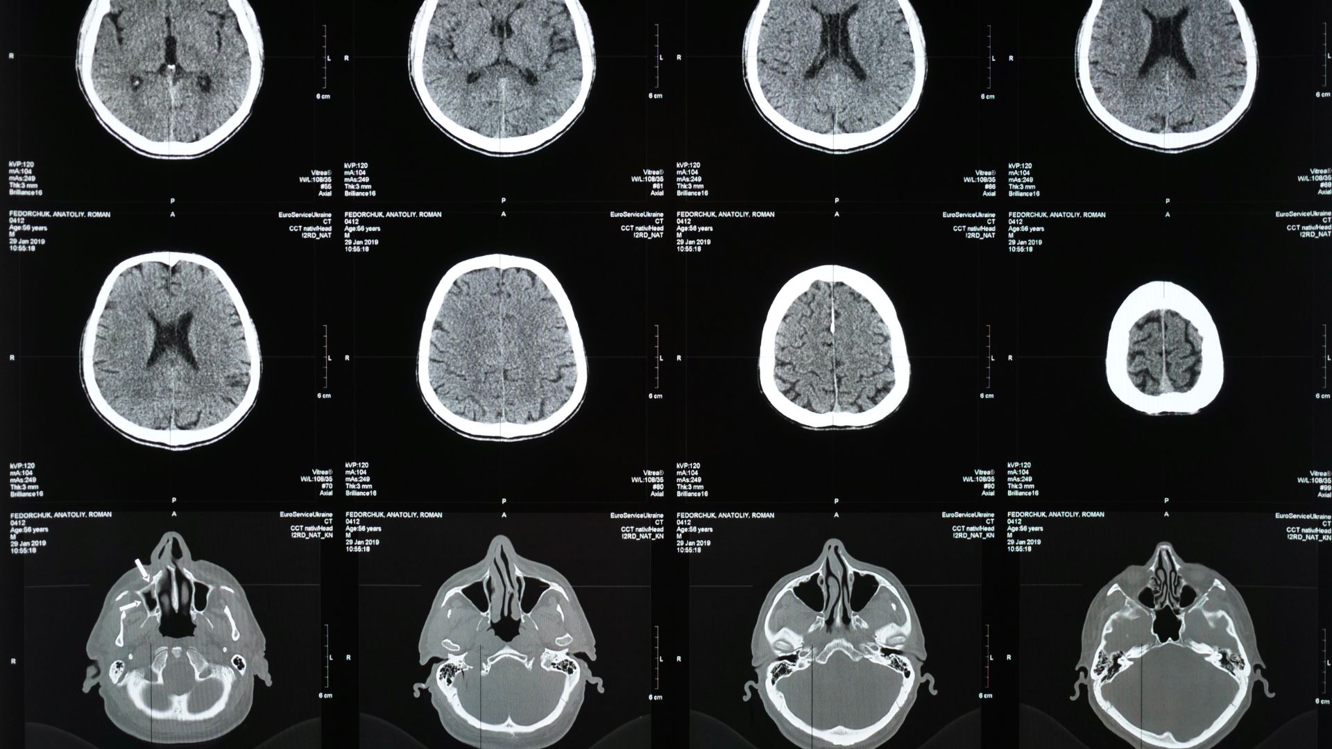 Chụp CT đóng vai trò quan trọng trong việc chẩn đoán hình ảnh chi tiết các dị tật ống thần kinh