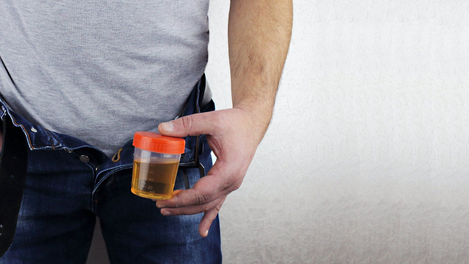 Một số bệnh gây đi tiểu ra máu nhưng không kèm theo triệu chứng khác và chỉ phát hiện qua xét nghiệm nước tiểu định kỳ