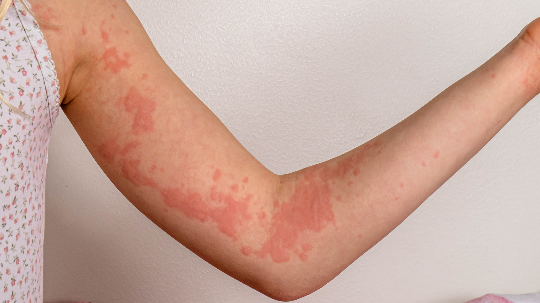 Ngứa ngáy, nổi mề đay là biểu hiện thường gây khi dị ứng cá