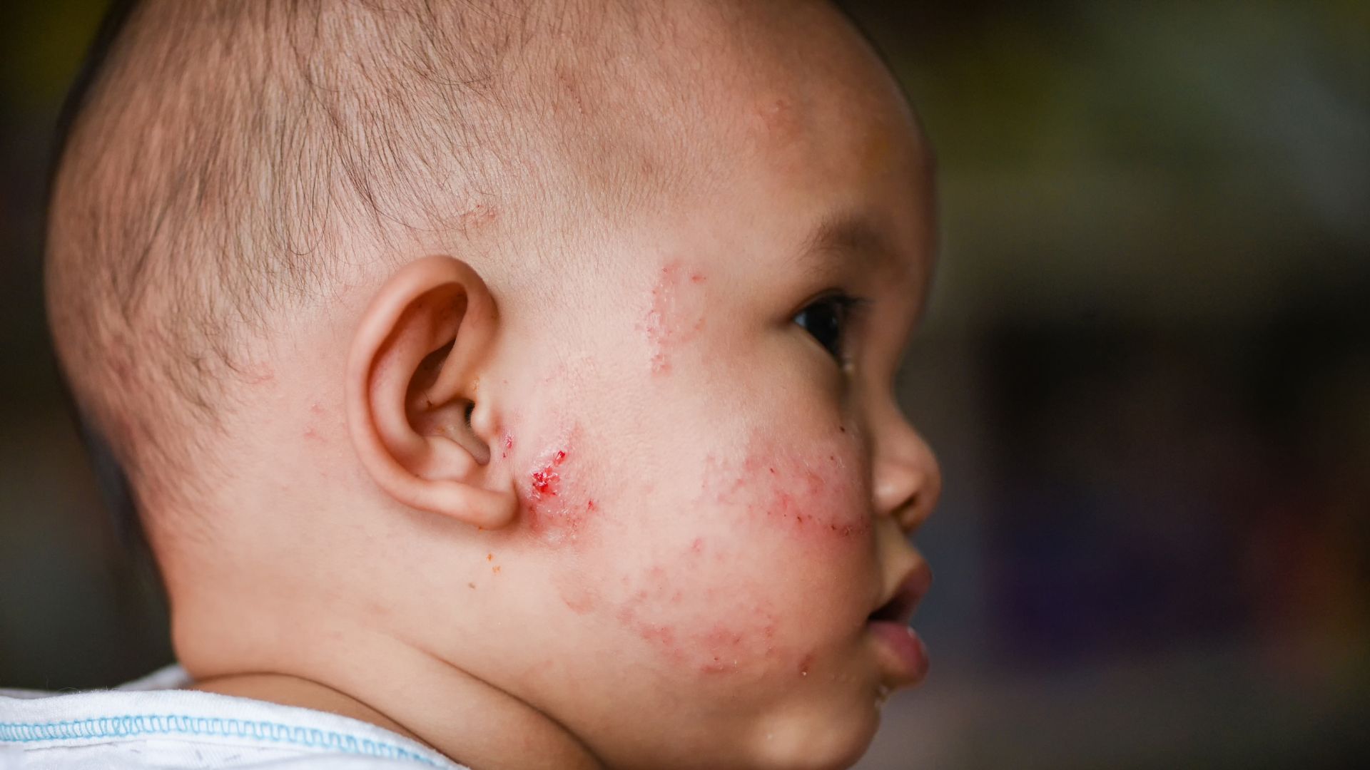 Dị ứng đạm sữa bò: Dấu hiệu và cách chăm sóc đúng 5