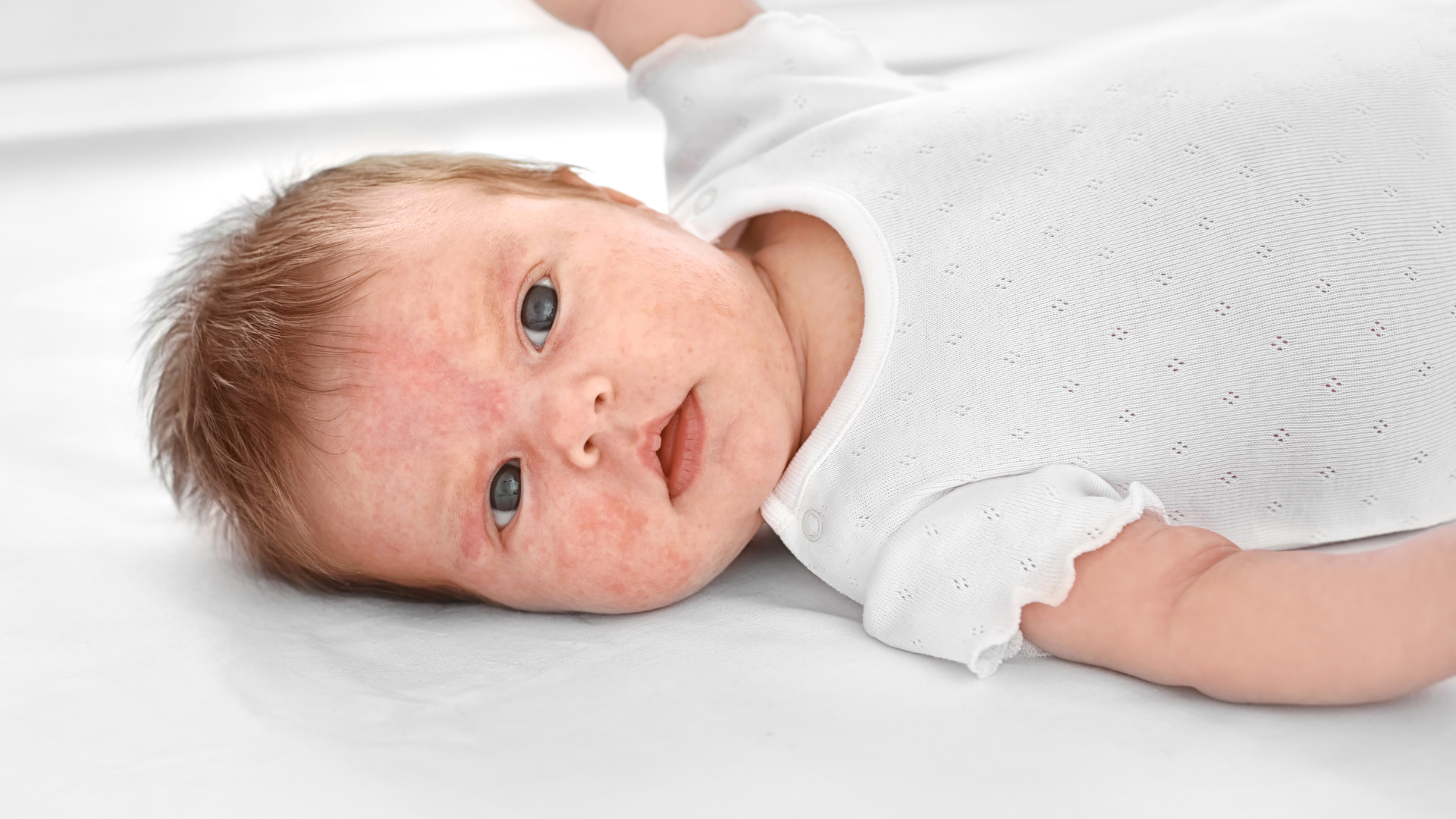 Phân biệt triệu chứng của dị ứng đạm sữa bò và bất dung nạp lactose