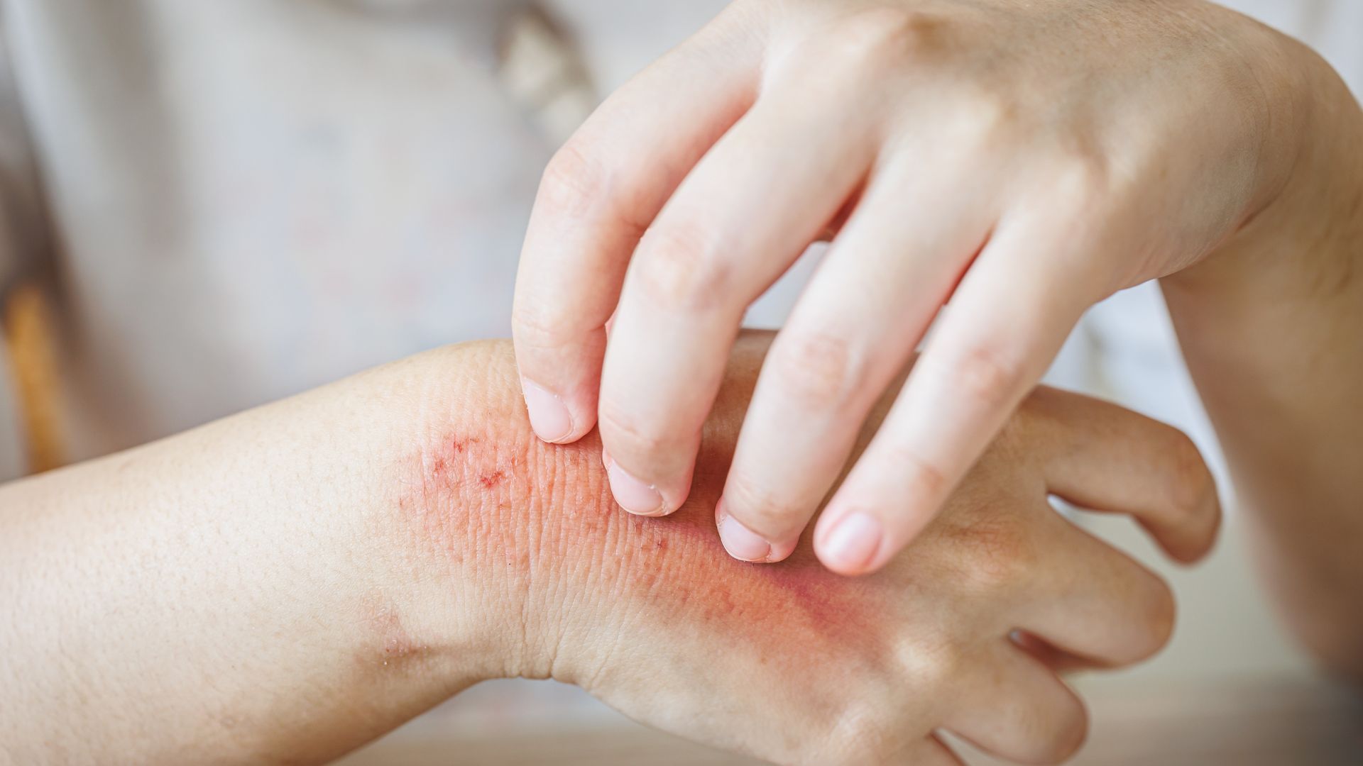 Dị ứng hải sản là gì? Cách nhận biết sớm và phòng tránh nguy hiểm 2